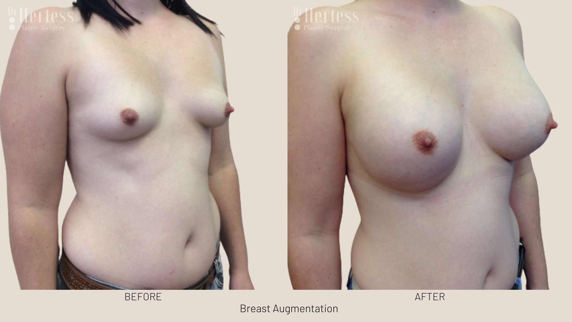 breast enlargement before after