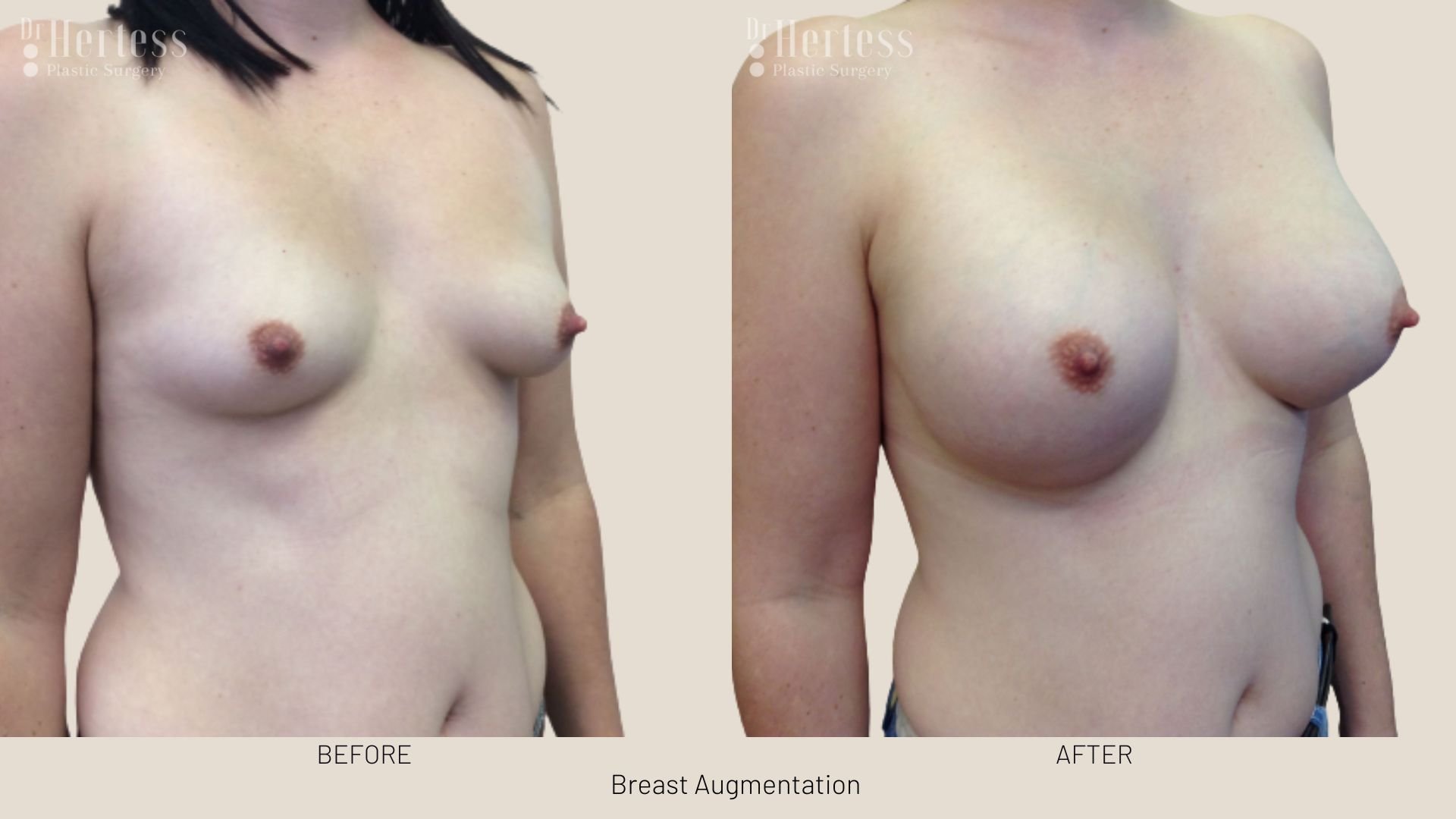 breast enlargement before after