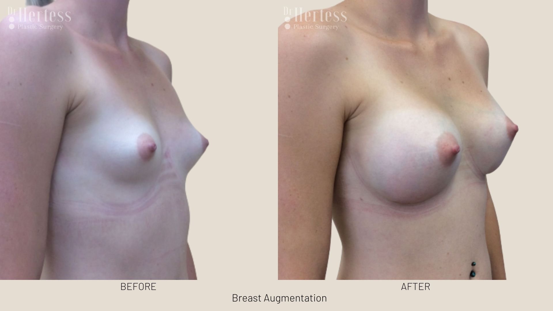 before and after breast augment