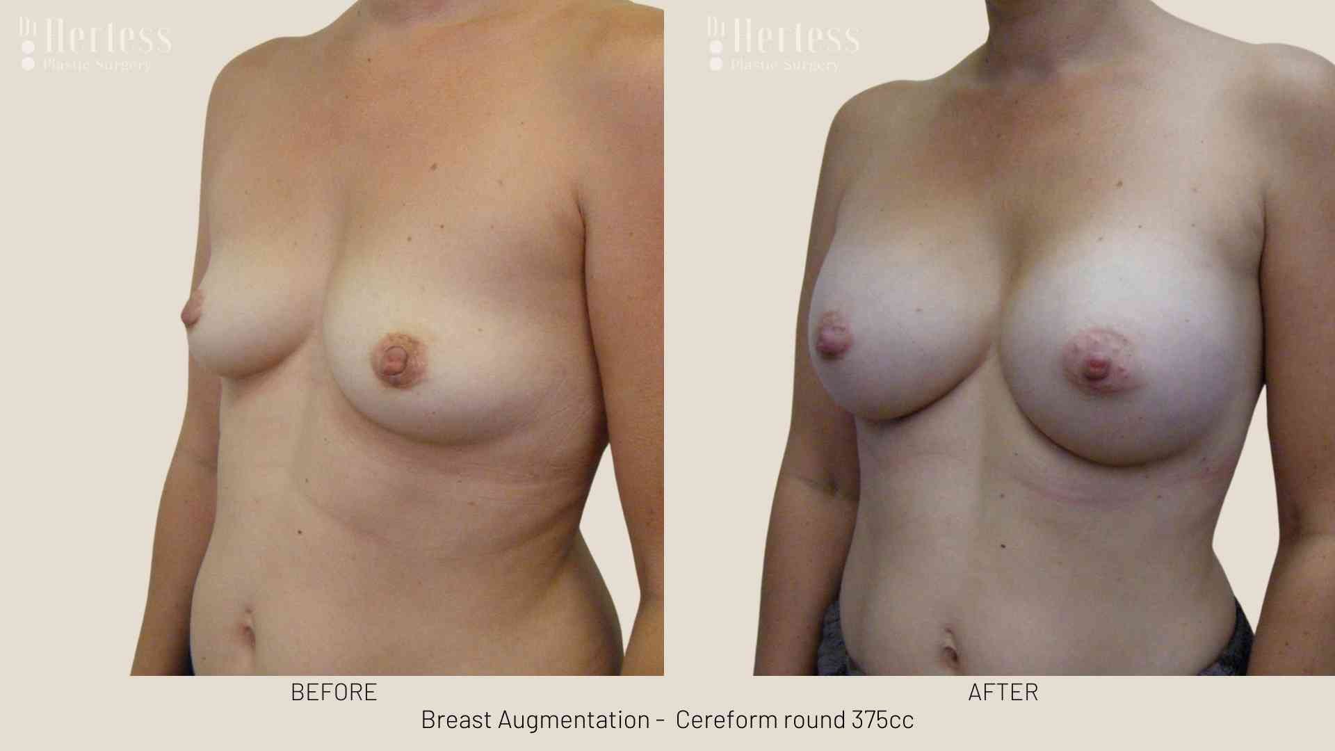 breast enhancement before and after