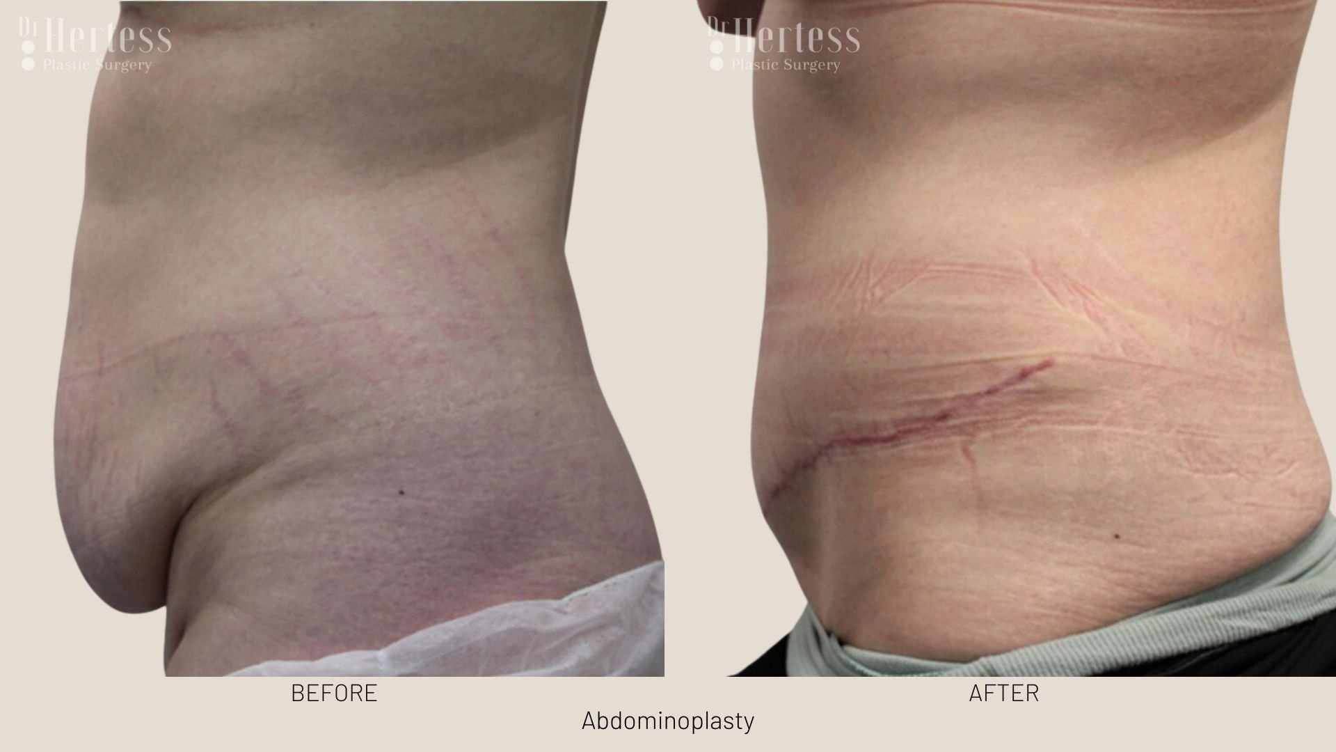 tummy tuck scars before and after