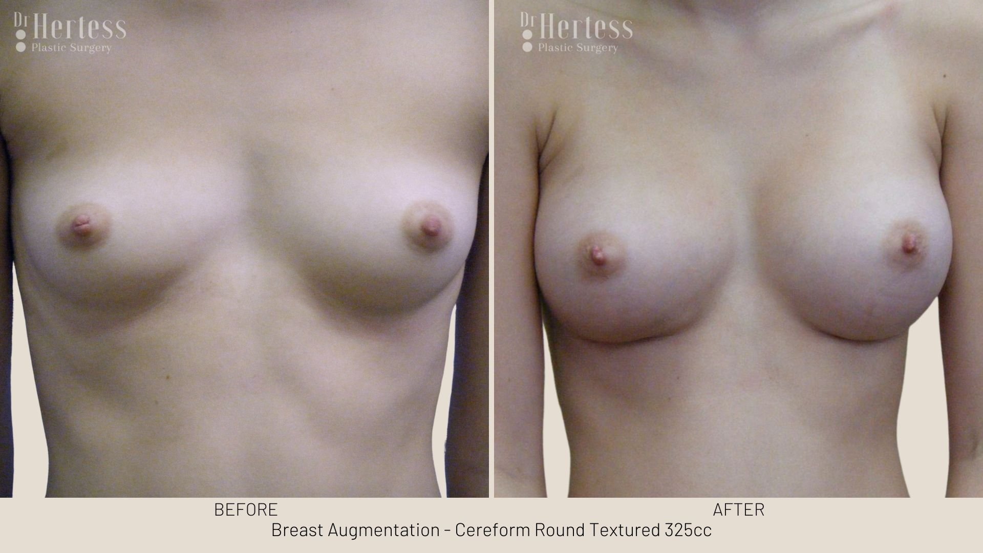 breast aug before and after
