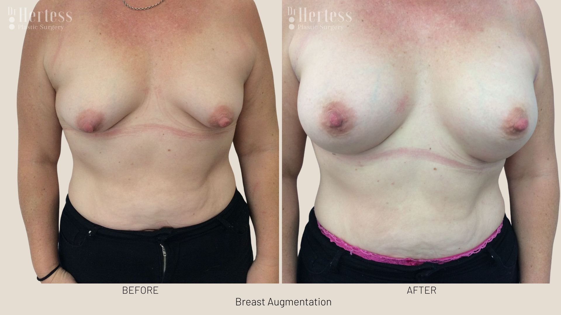 before and after breast augment