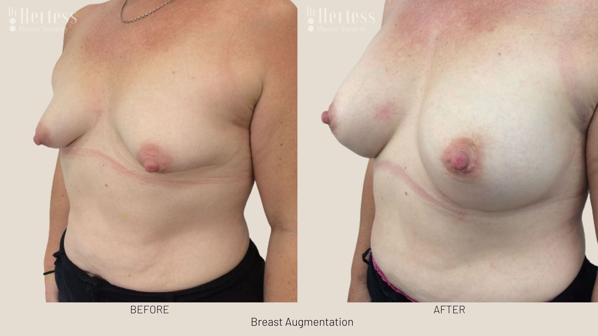 before and after breast augment