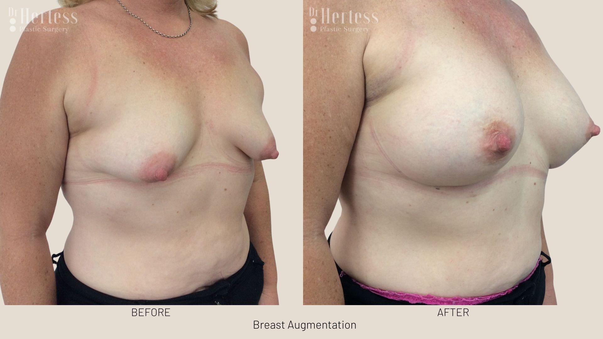 before and after breast augment