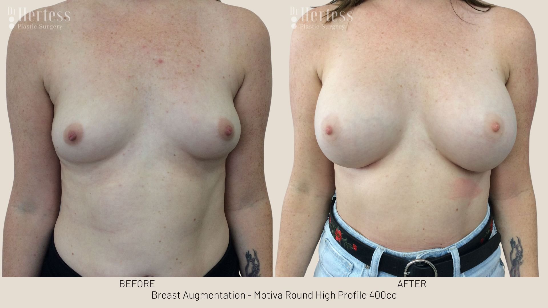 breast augmentation before and after