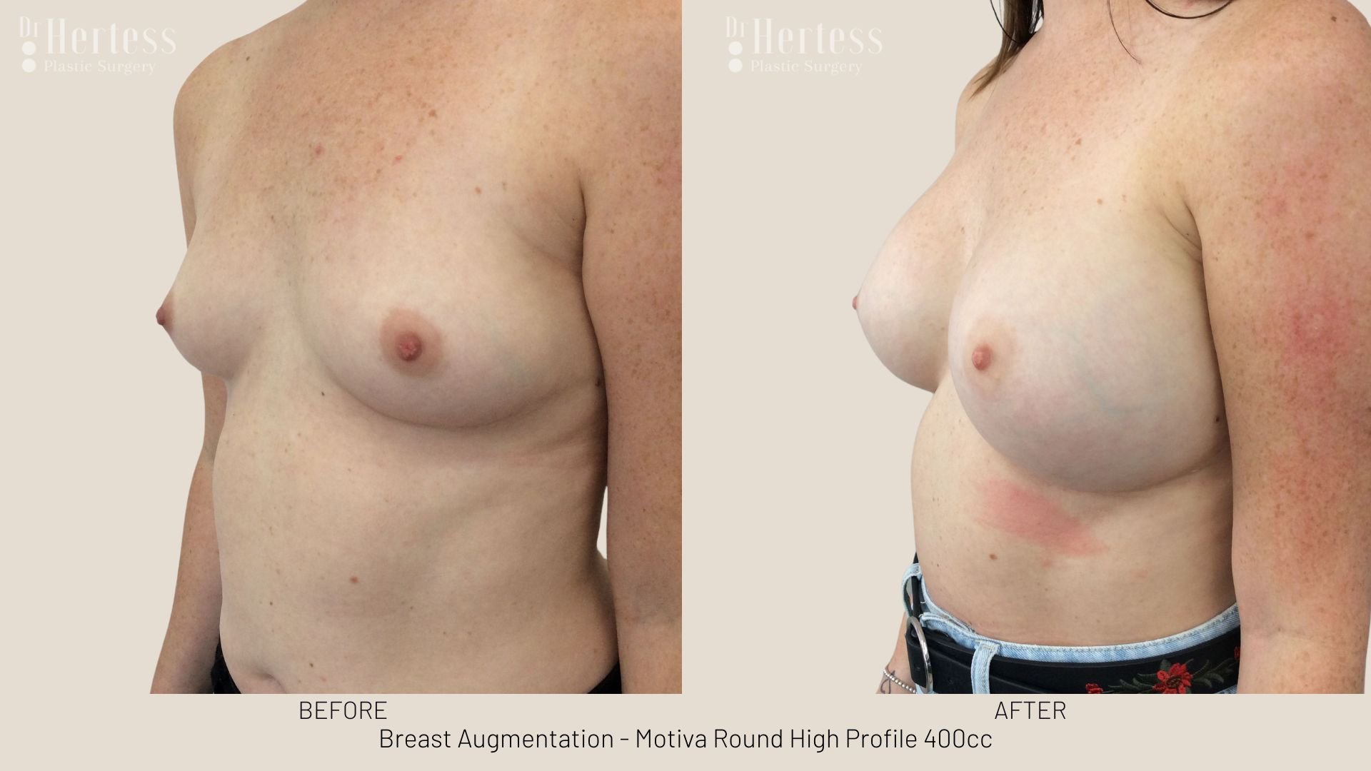 breast augmentation before and after