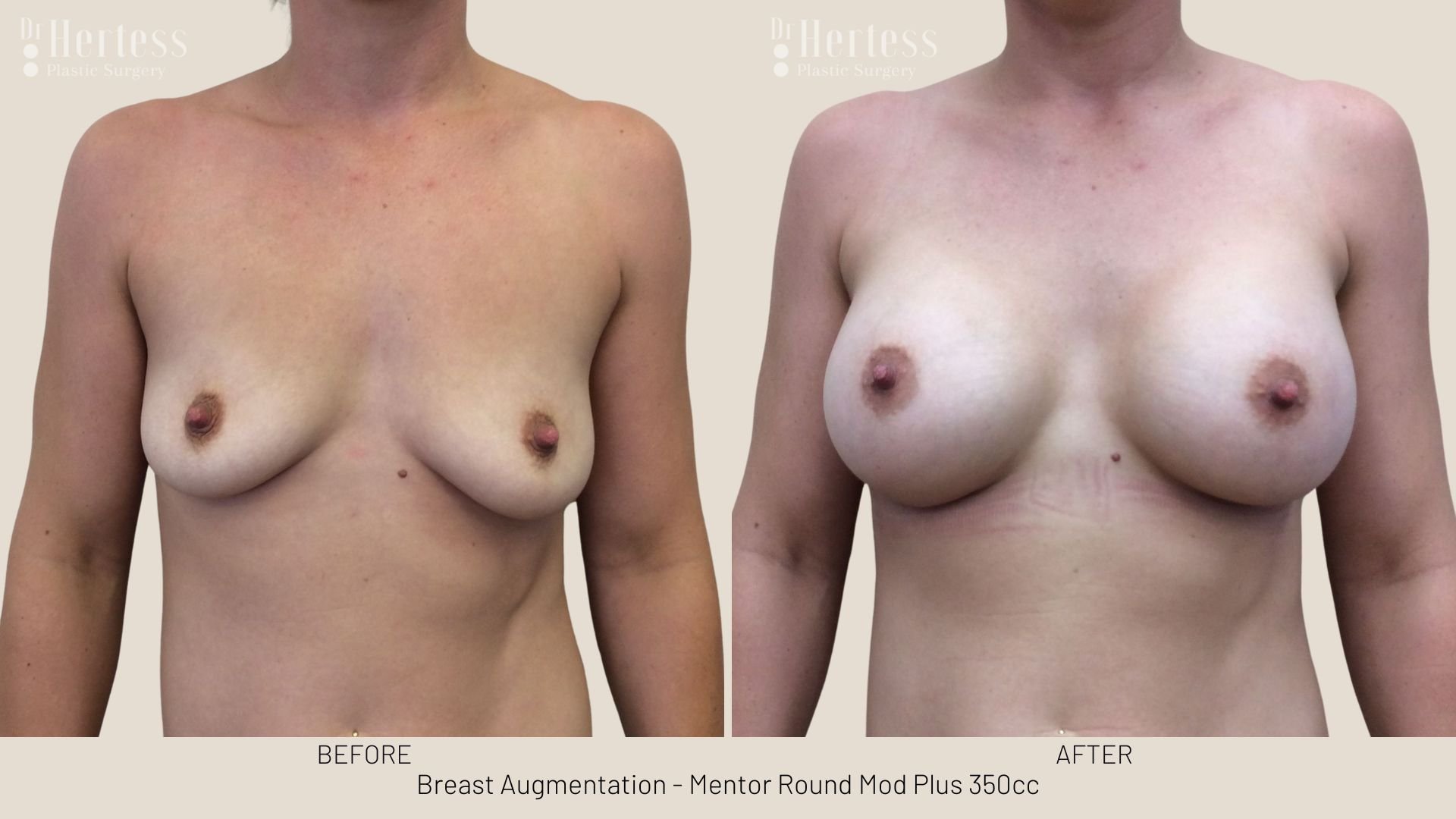 breast augmentation before and after