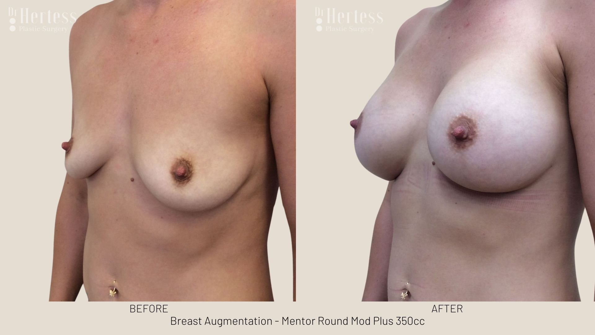 breast augmentation before and after