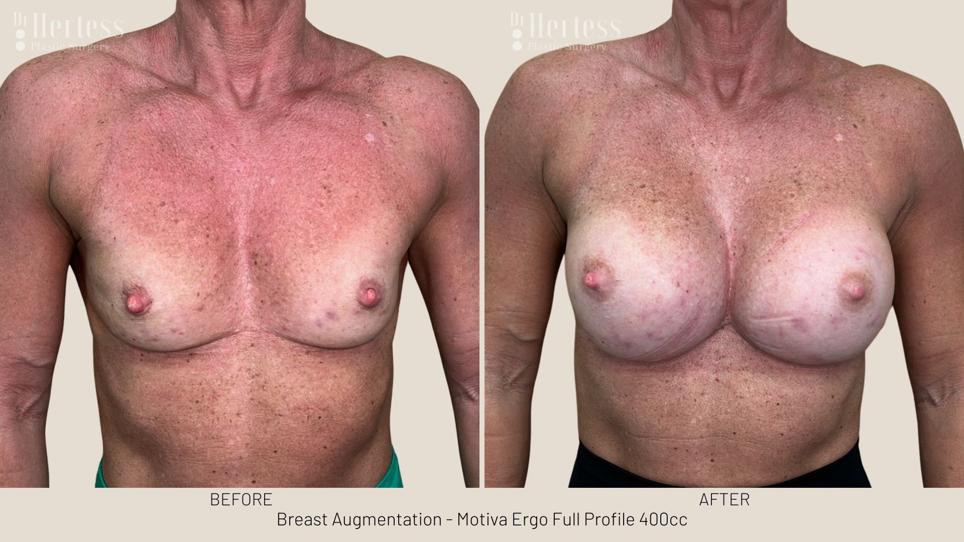 breast augmentation before and after