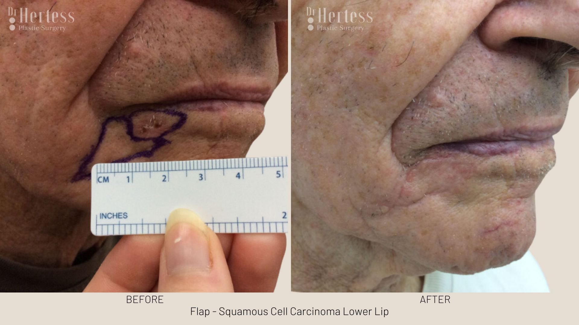 basal cell carcinoma