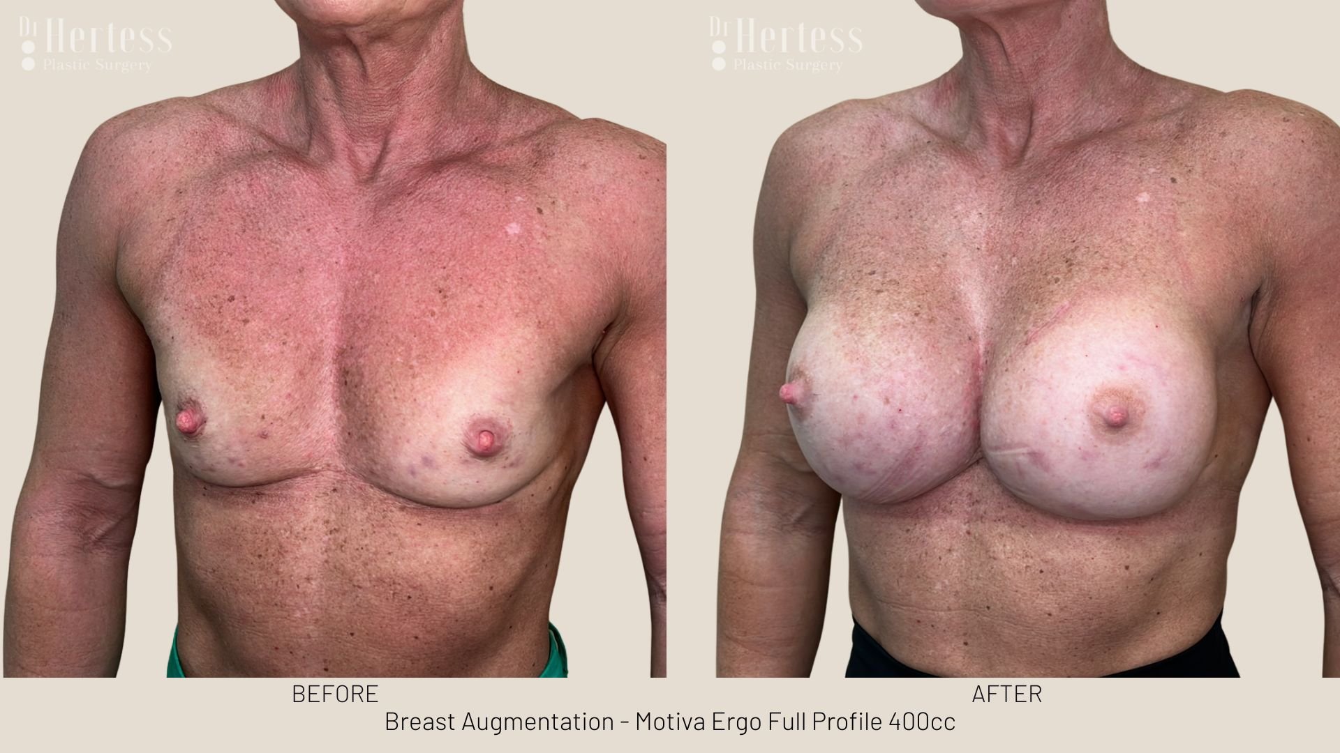 breast augmentation before and after