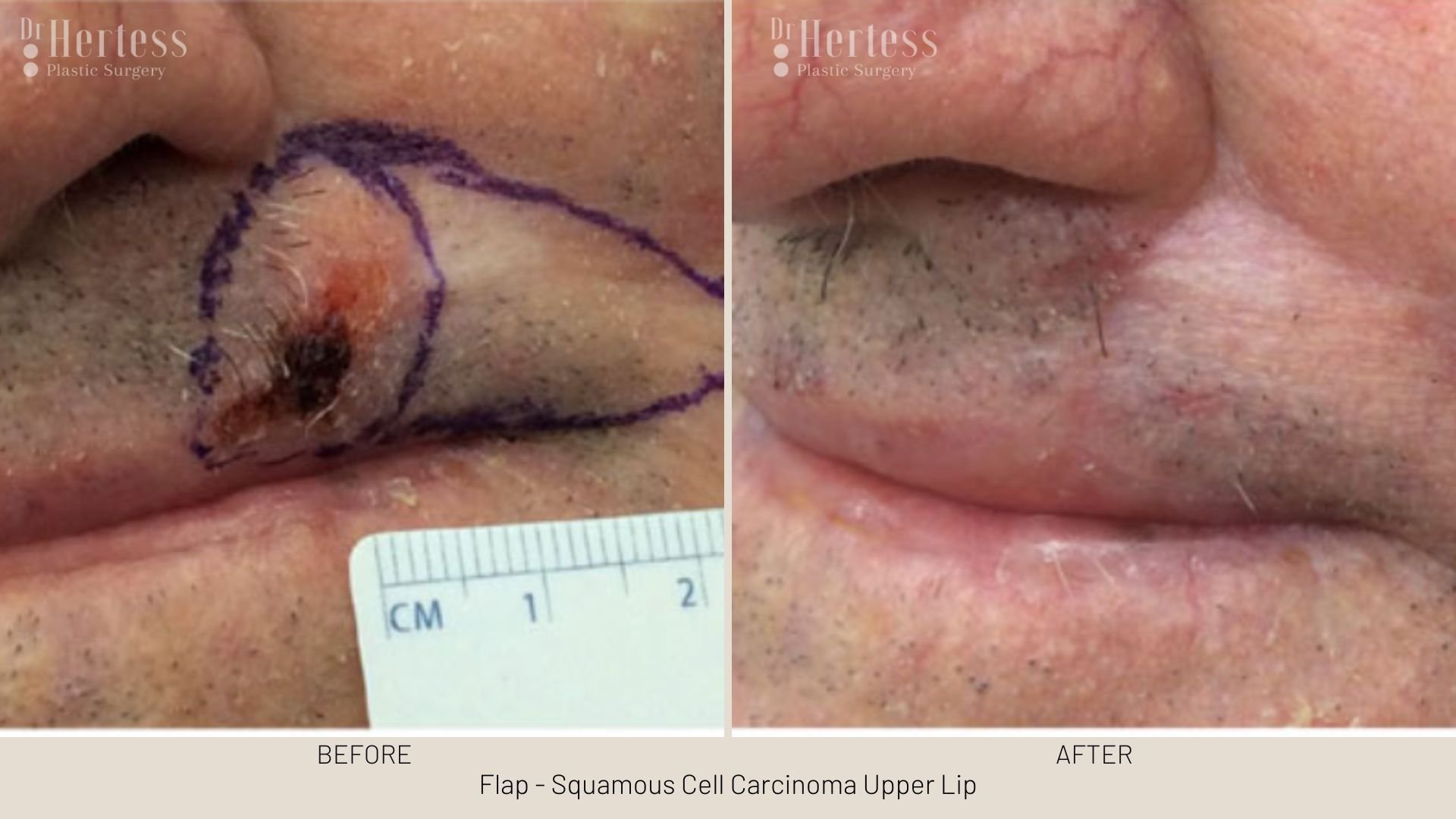 basal cell carcinoma