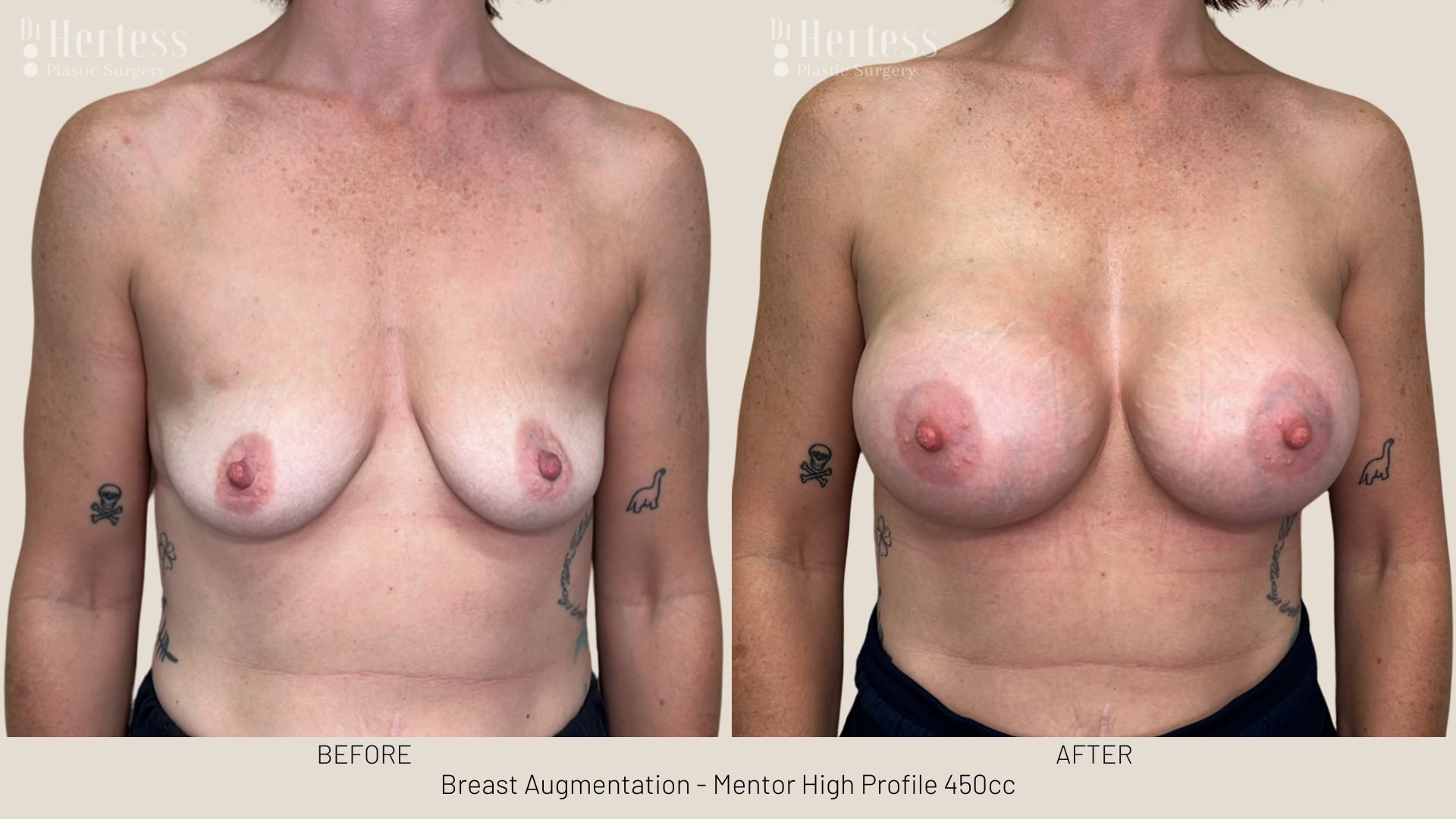 breast augmentation before and after