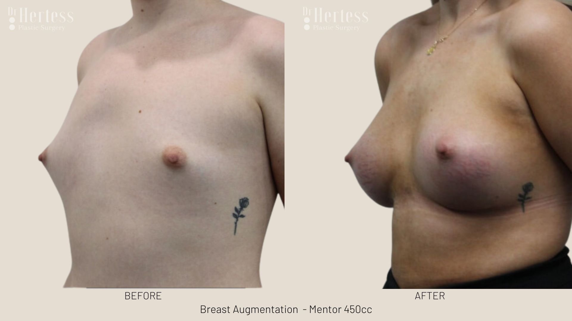 boob augmentation before and after