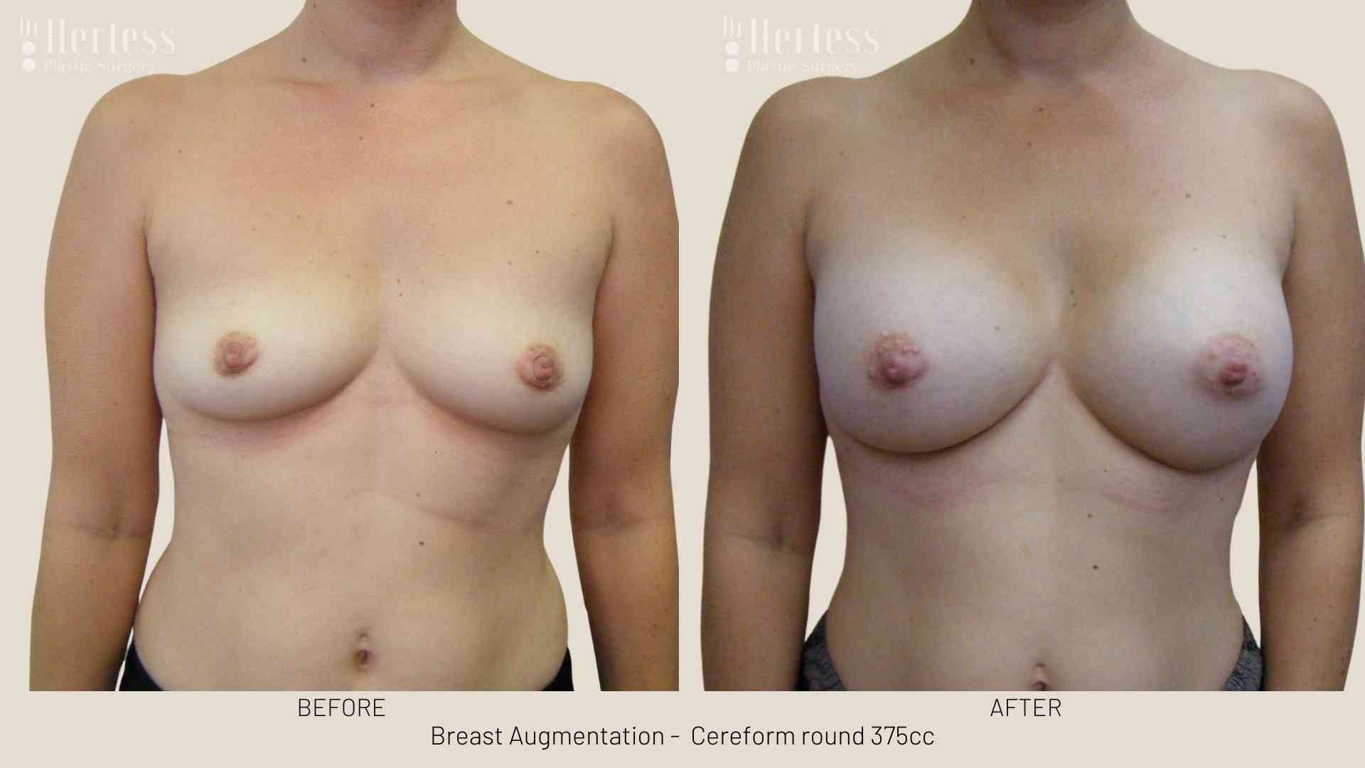 breast enhancement before and after