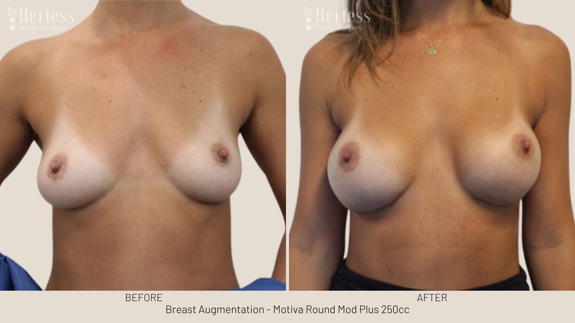 breast aug before and after