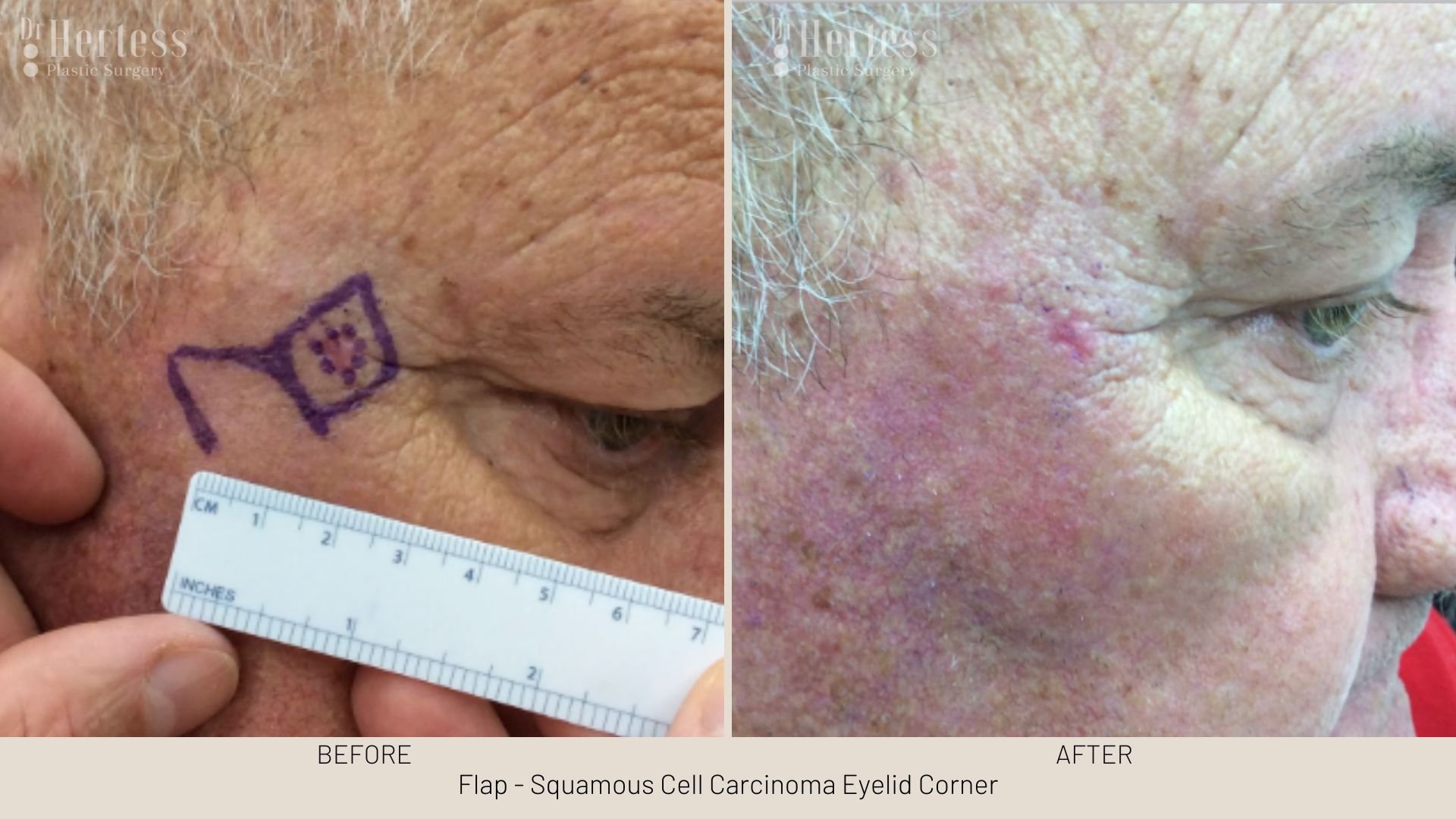 basal cell carcinoma