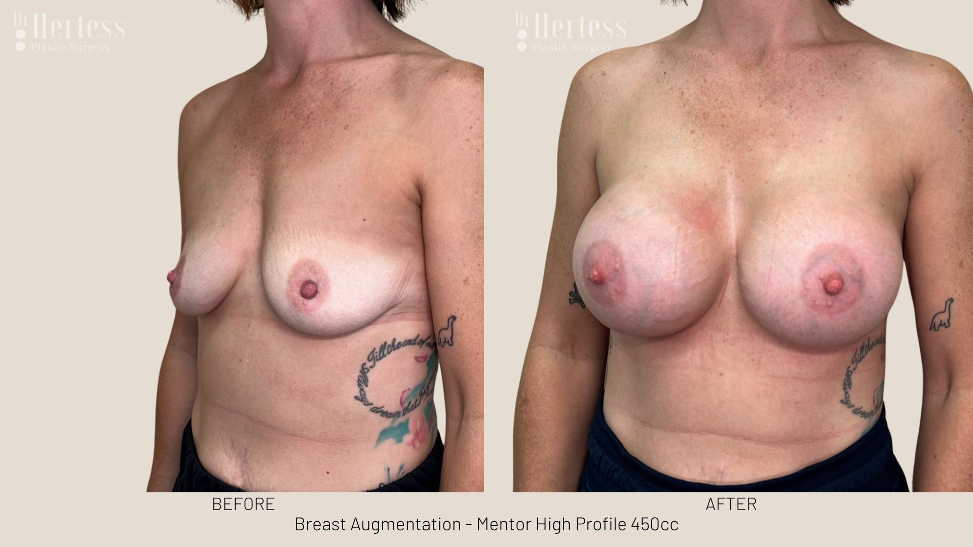 breast augmentation before and after