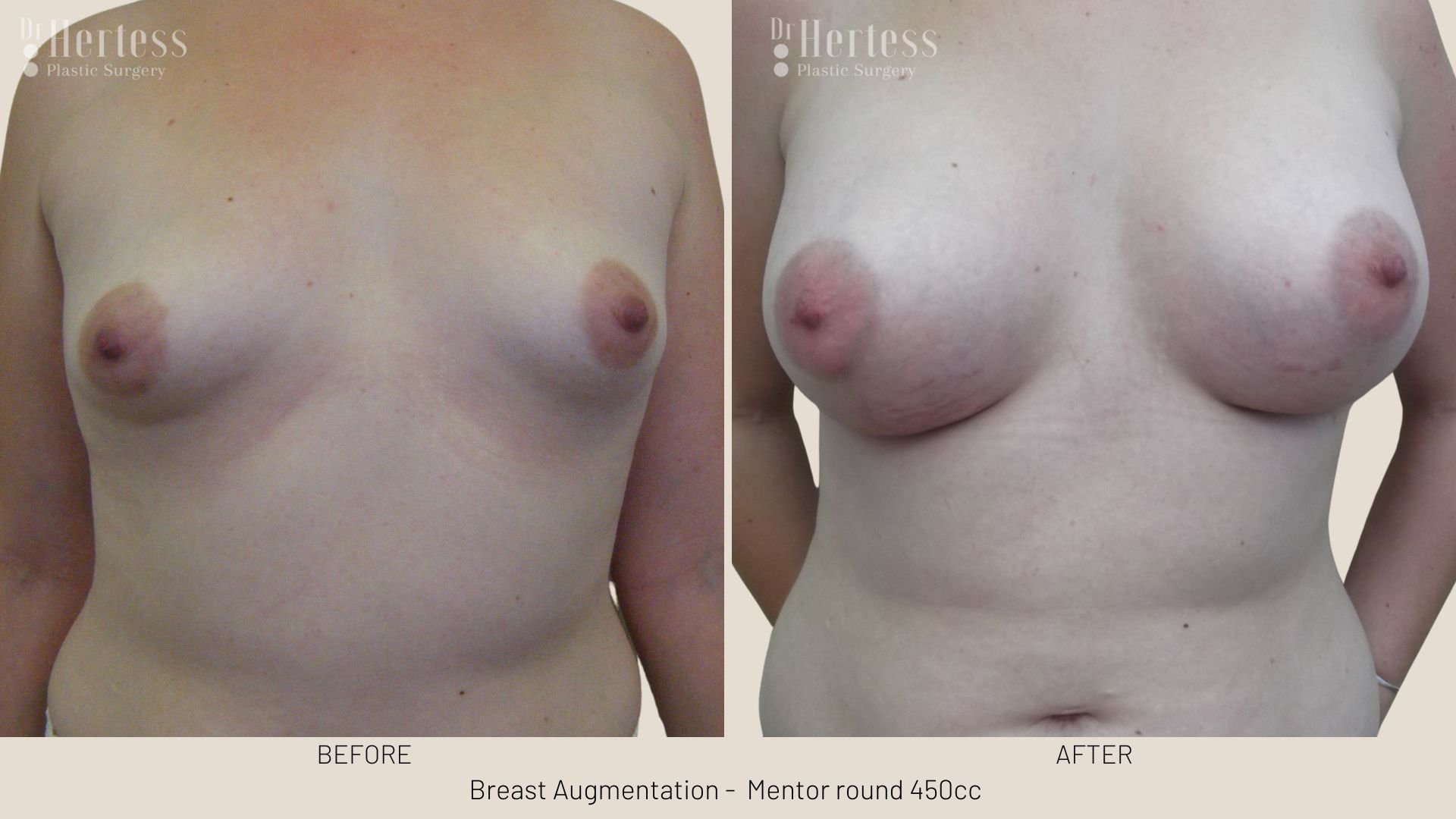 boob augmentation before and after