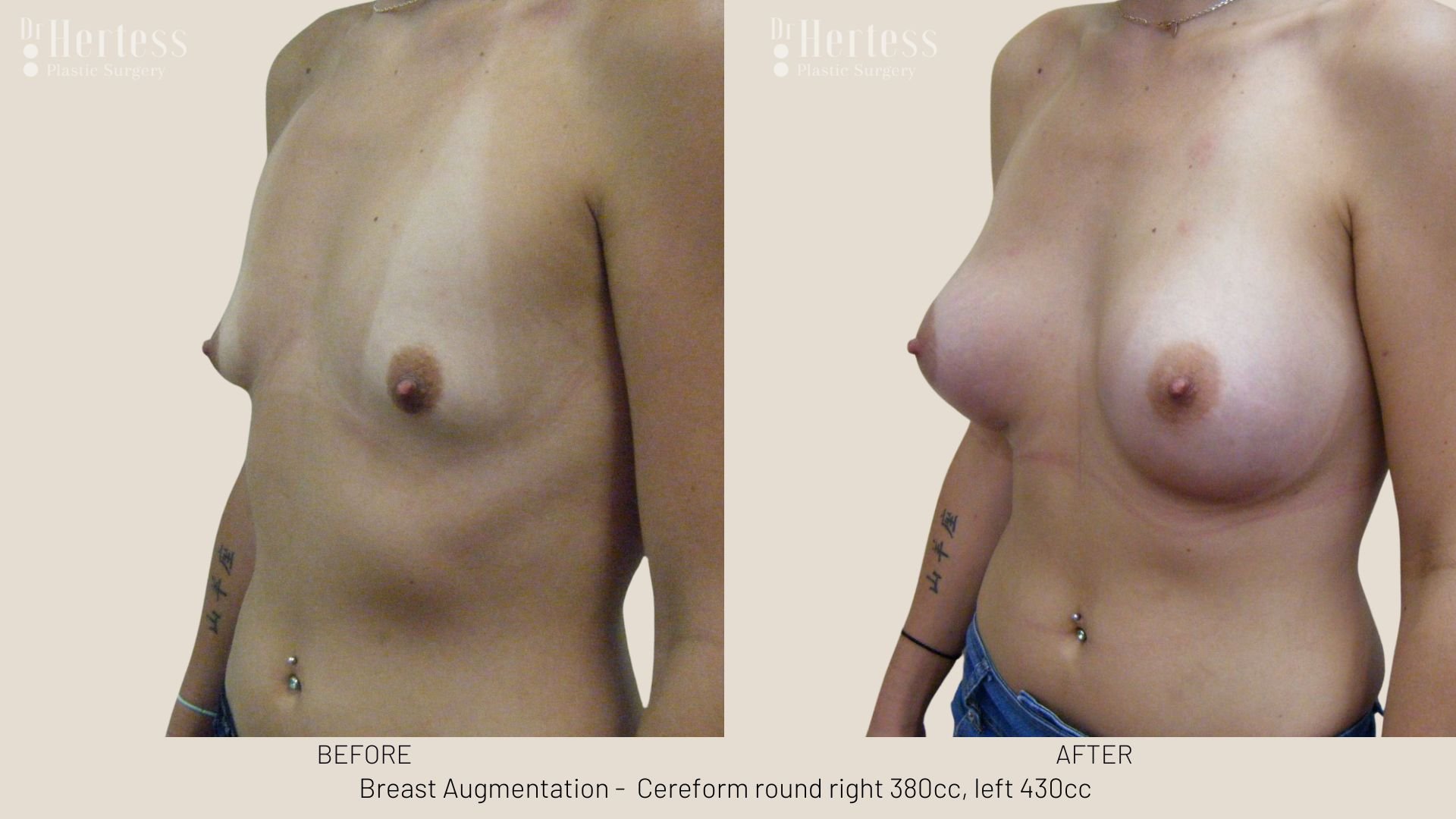 boob augmentation before and after