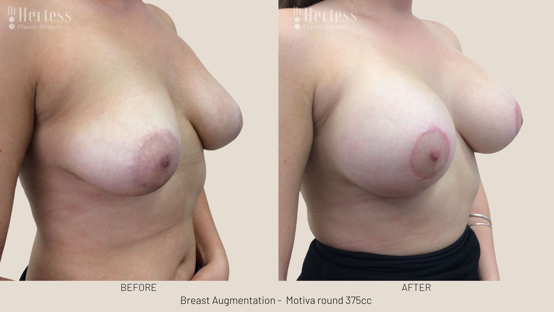 boob augmentation before and after