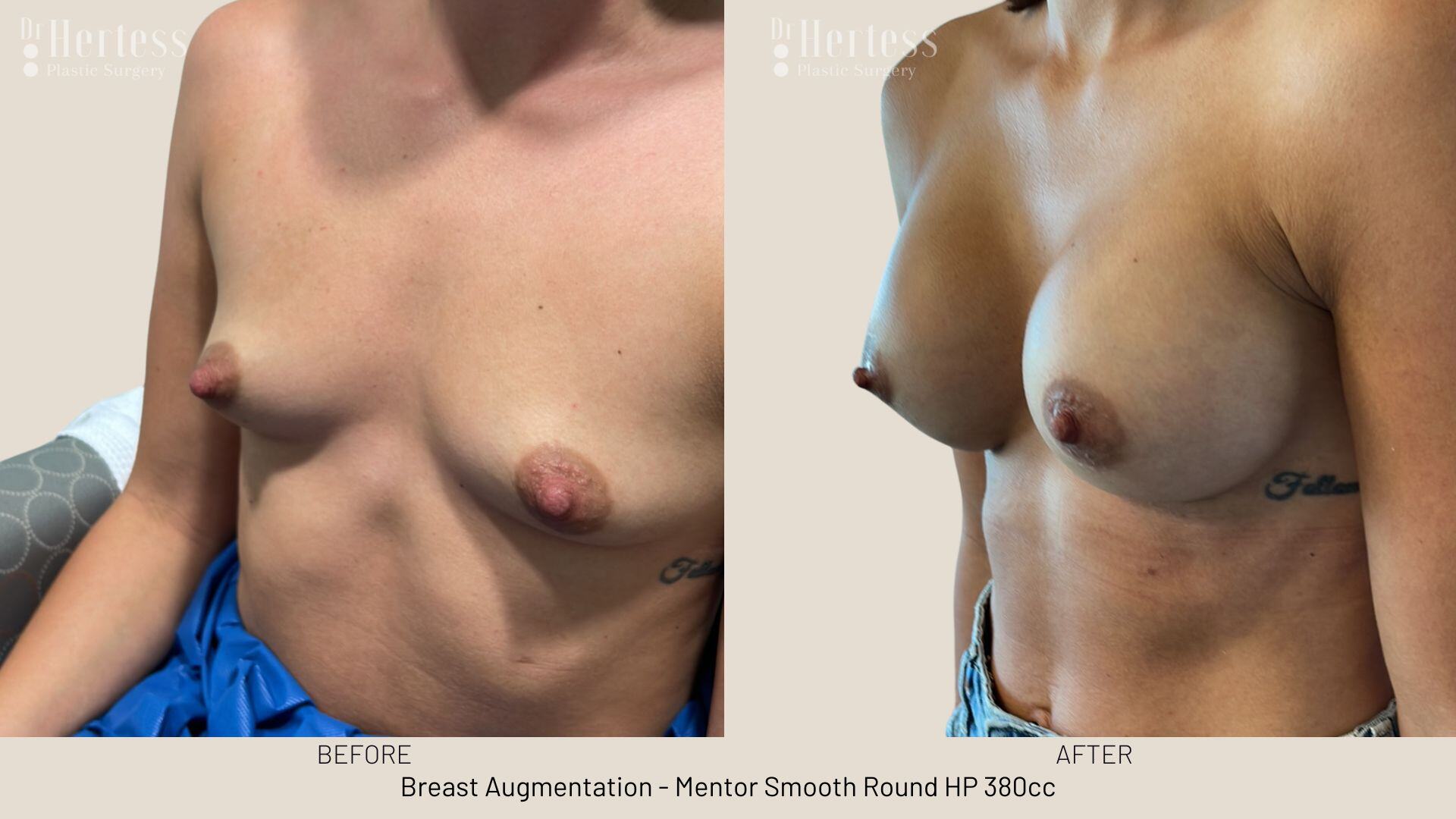 breast implants before and after