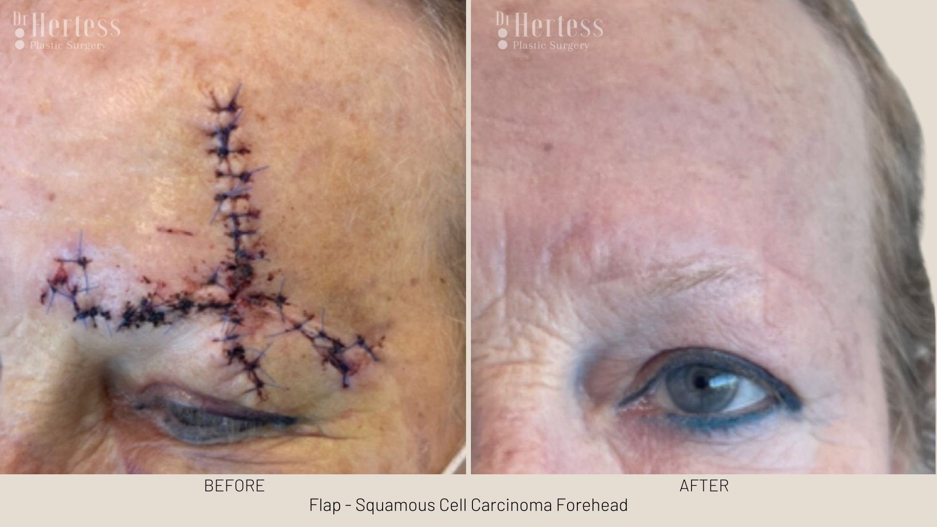 skin cancer removal