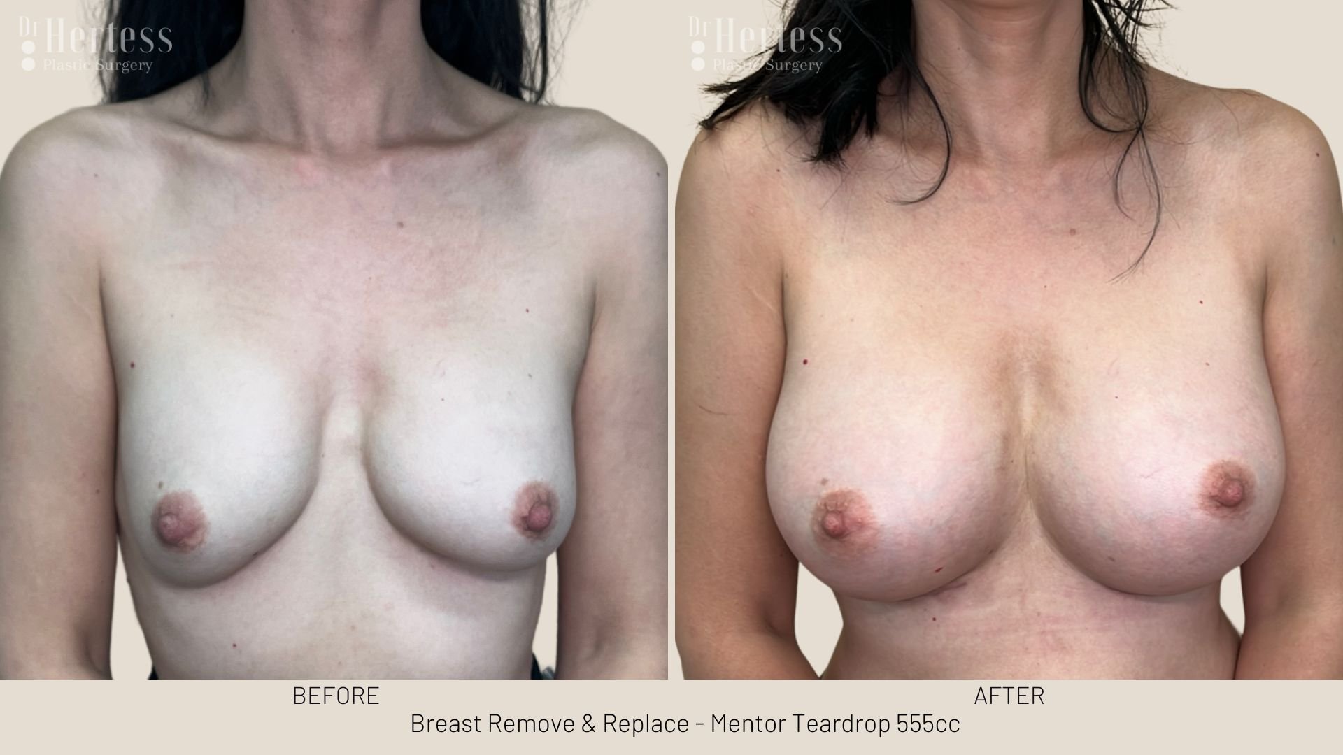 breast implant removal and replacement