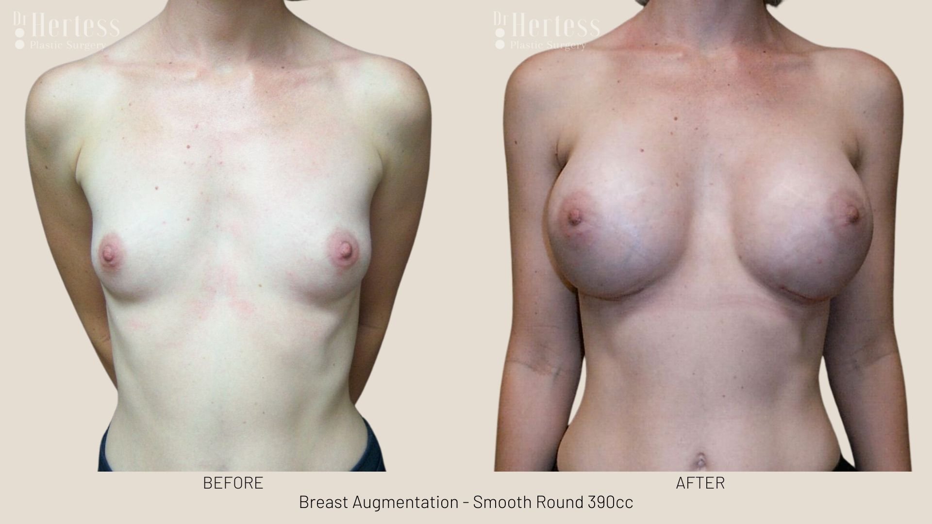 breast enlargement before and after