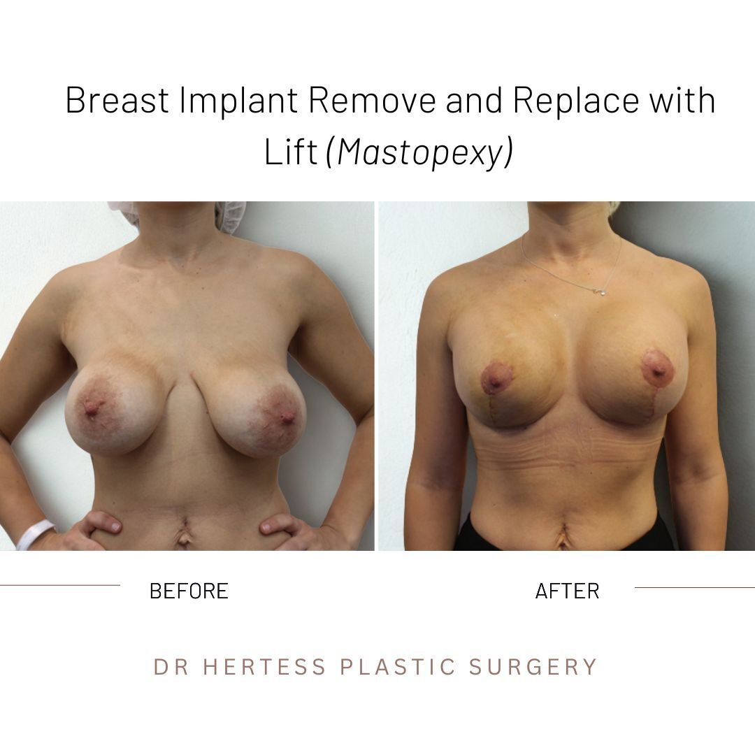 before and after breasts