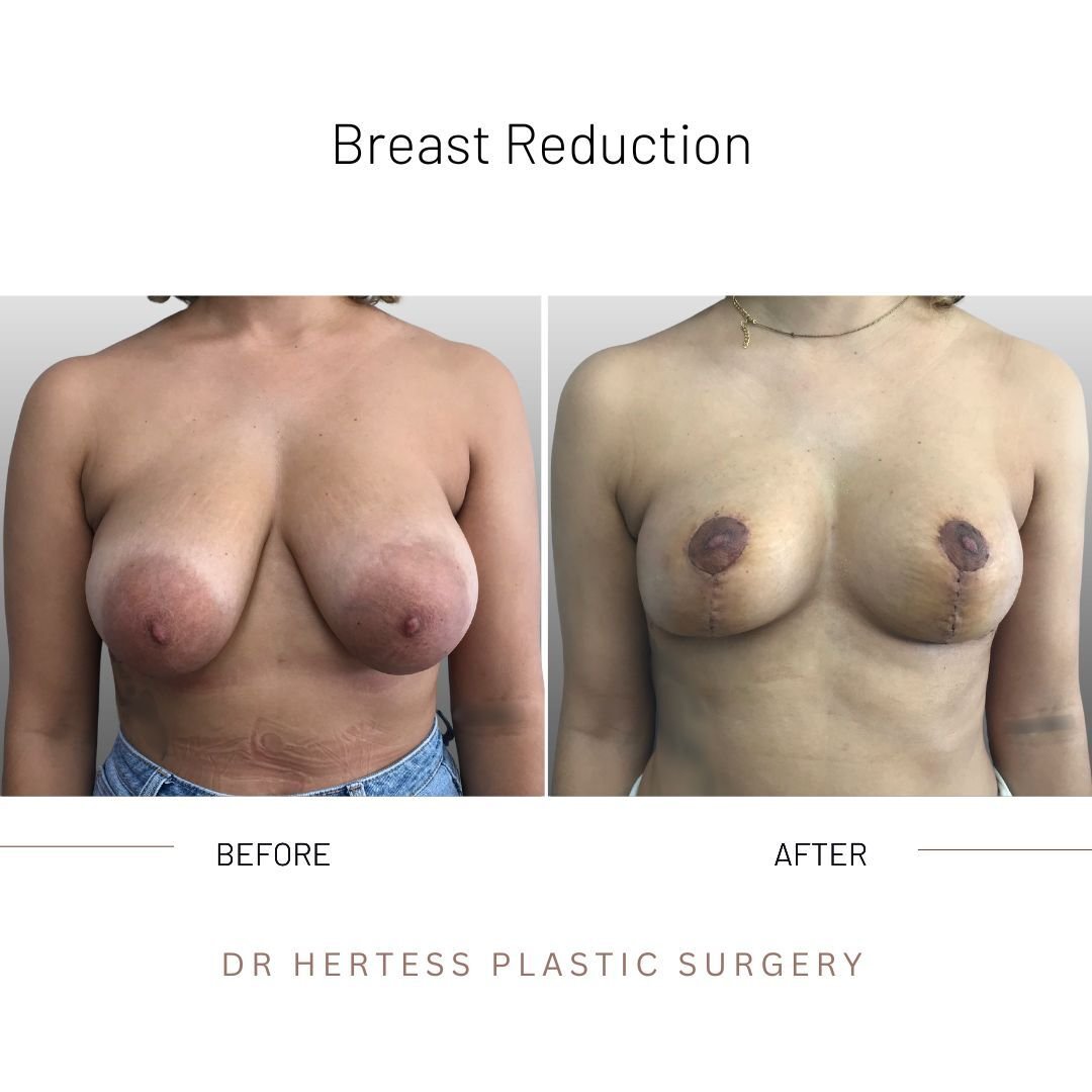 before and after breast reduction