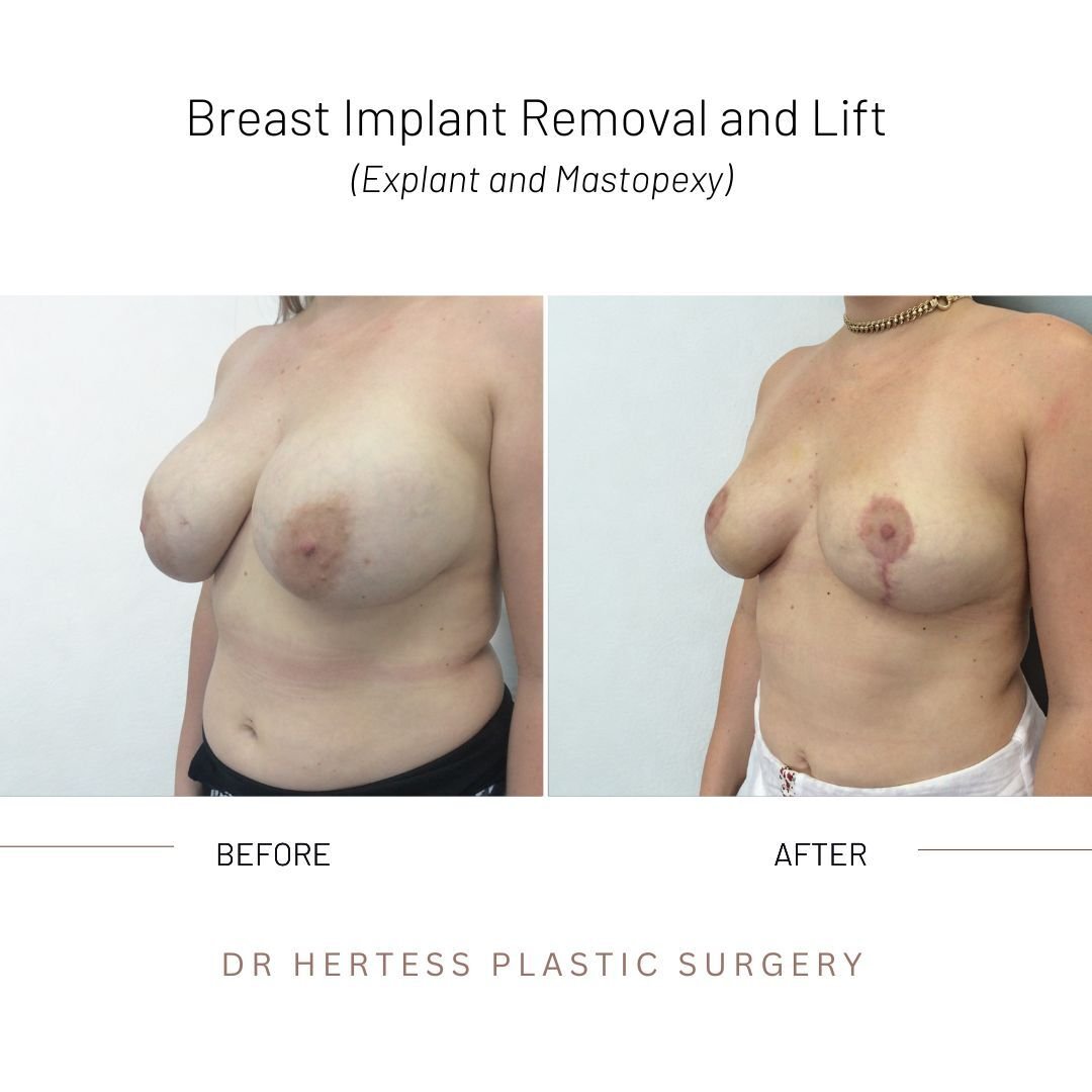 removal and lift before after