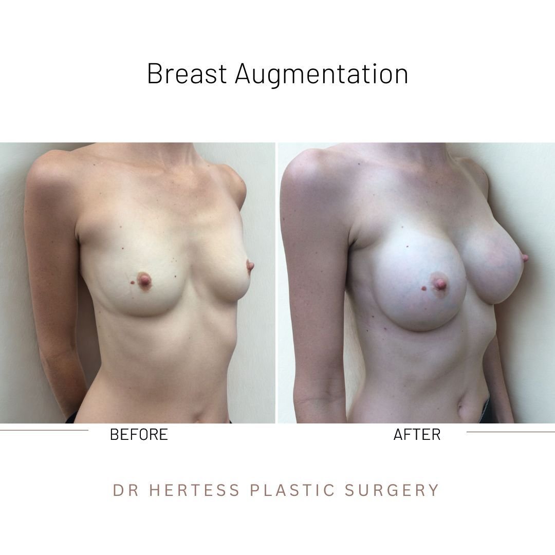 boob job before and after