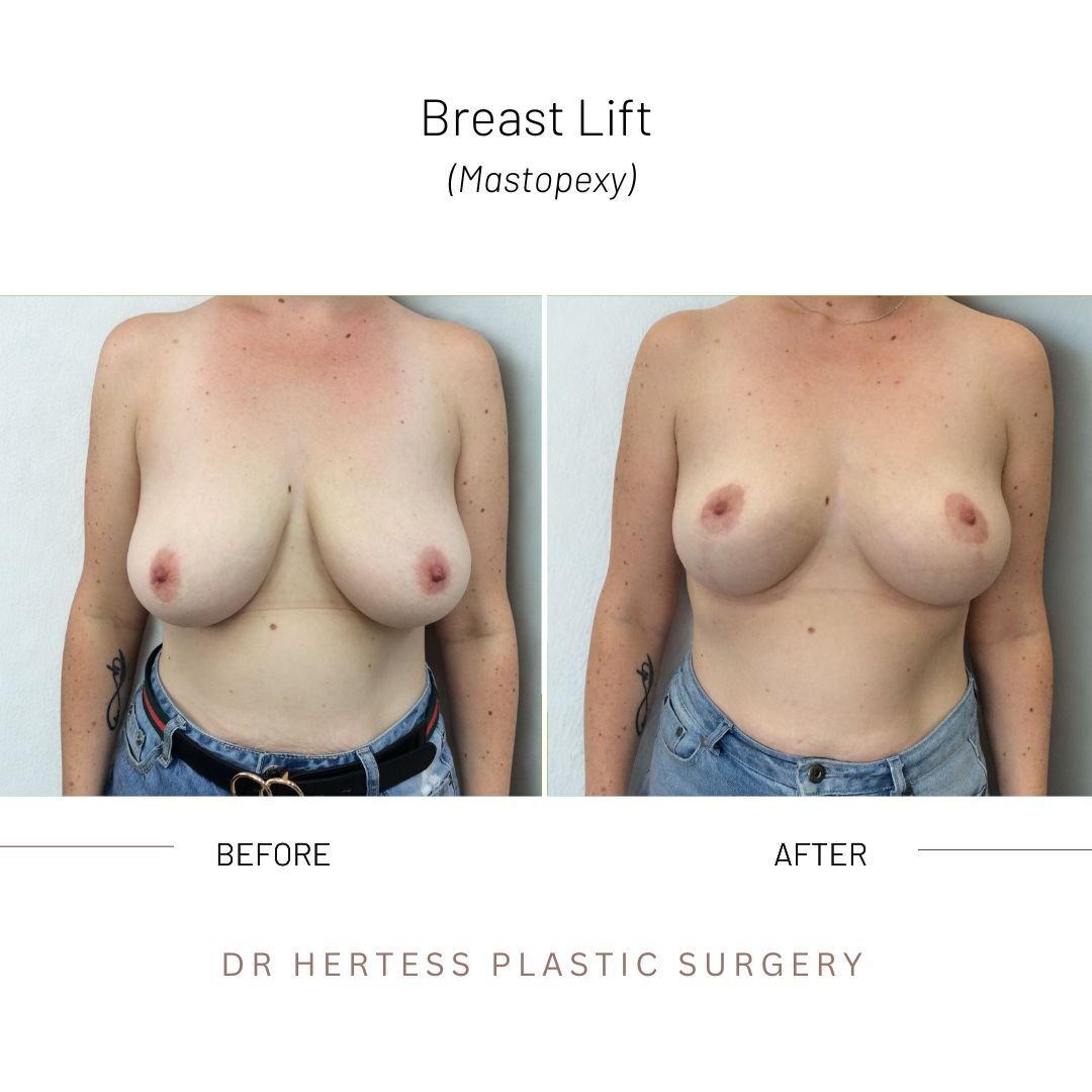 breast lift before and after