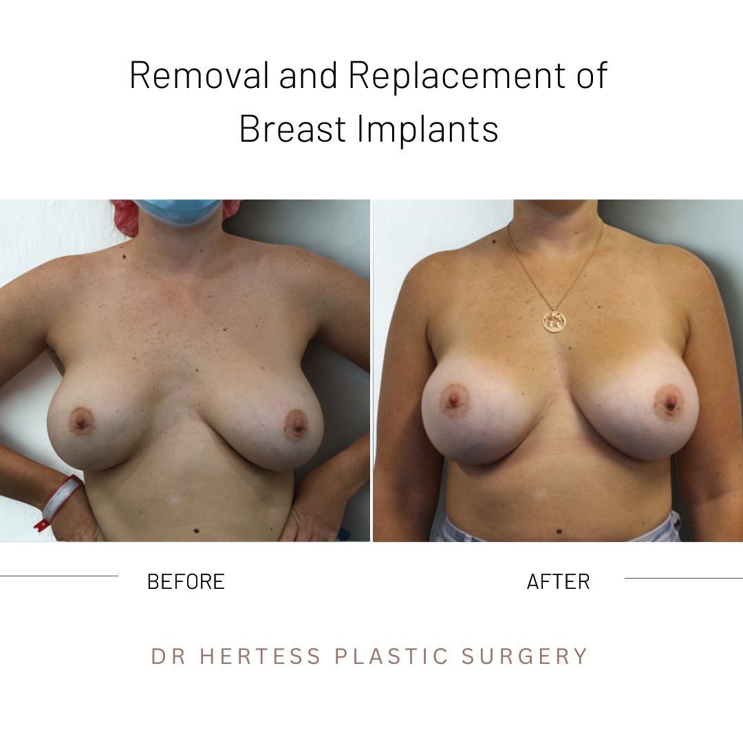 breast implant remove replace before and after