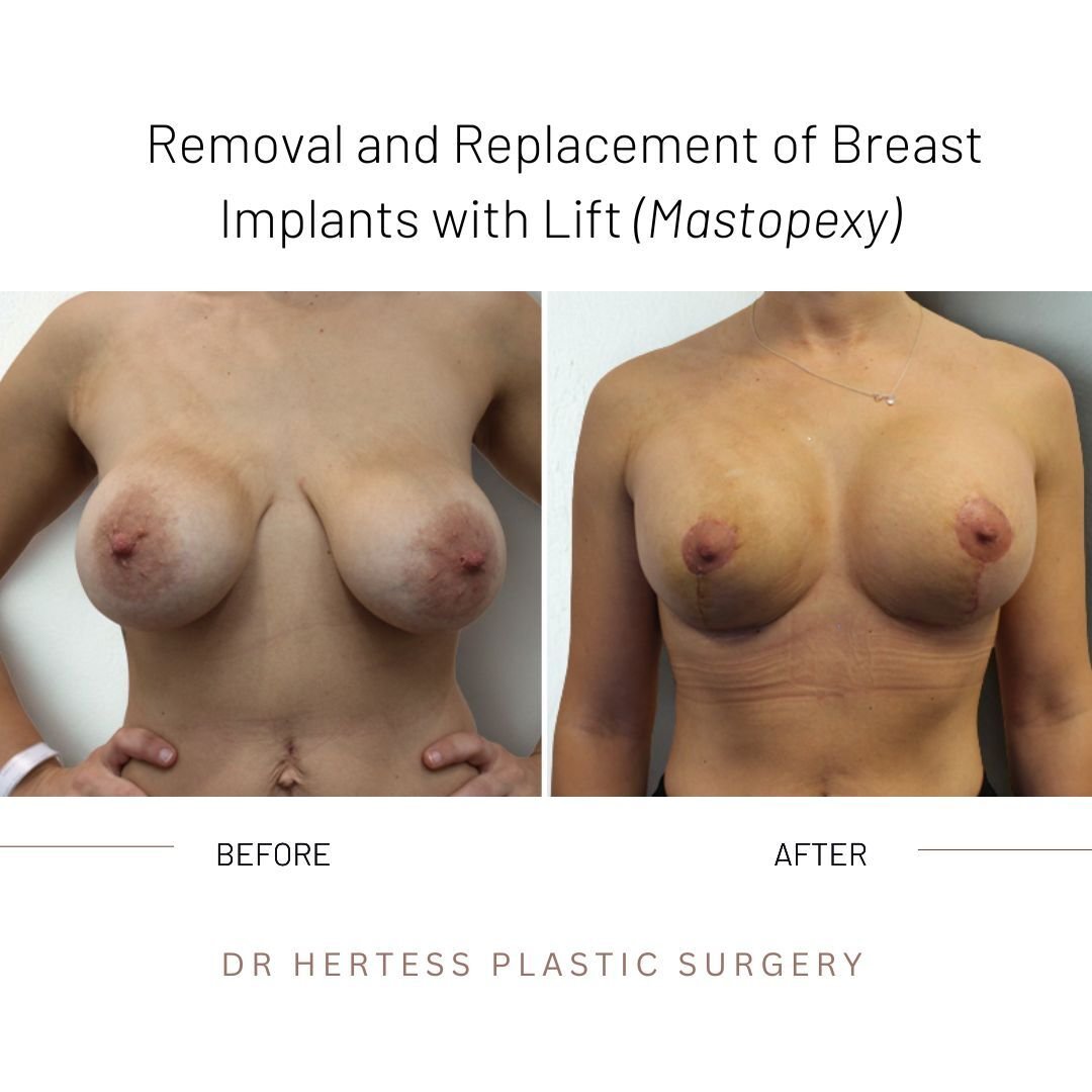 breast remove and replace before and after