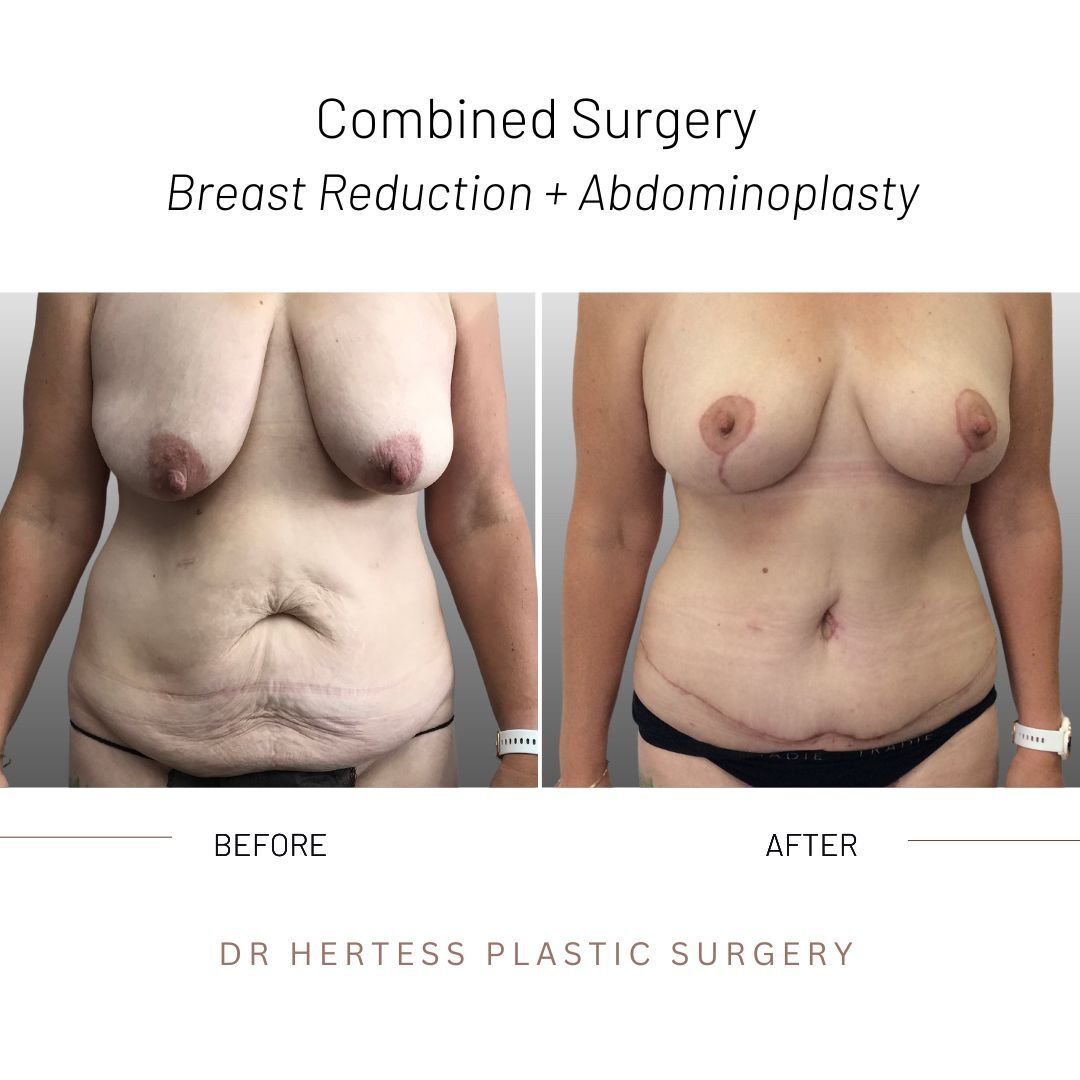 Mummy makeover before after