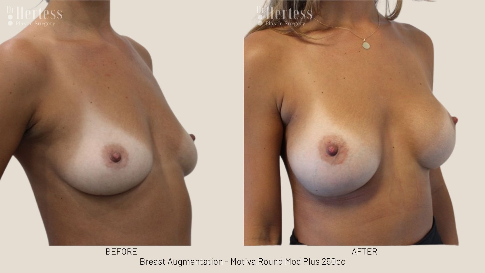 breast aug before and after