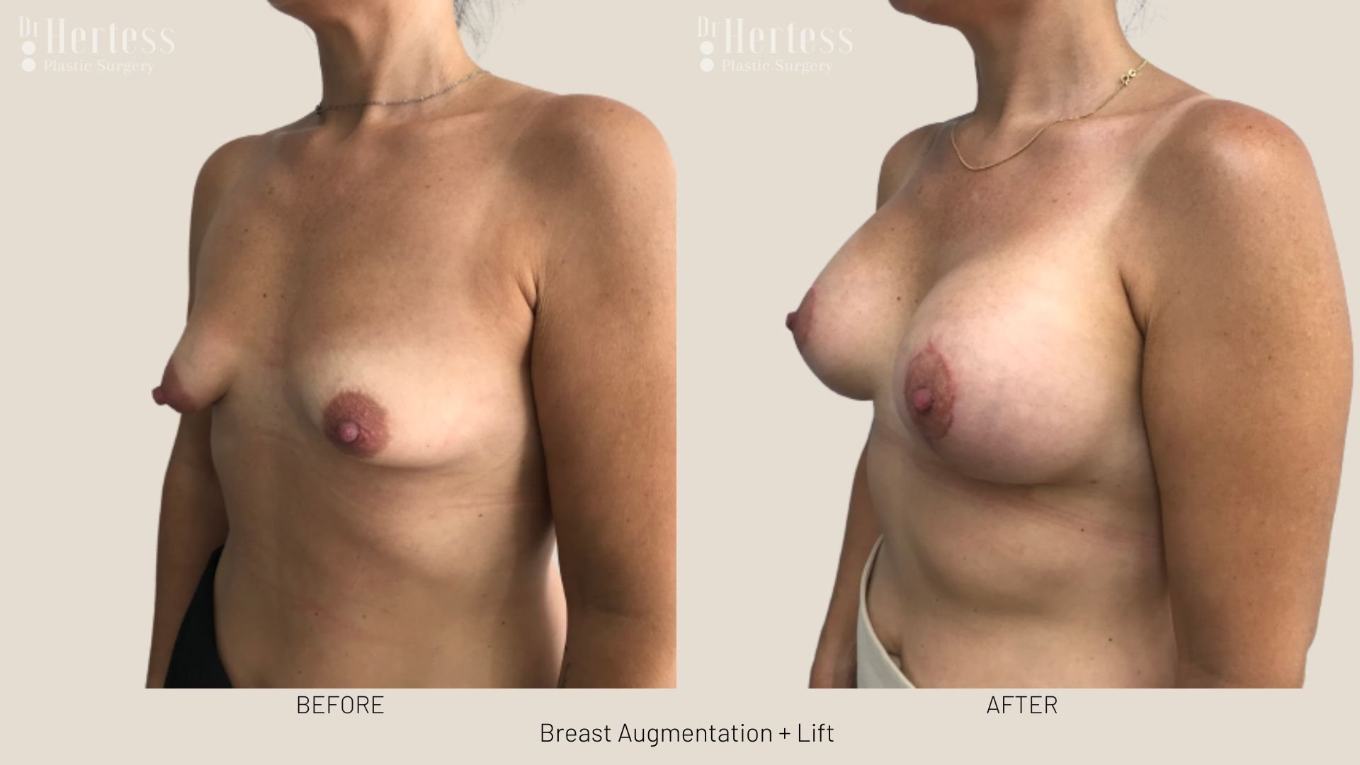 breast lift and augmentation before and after