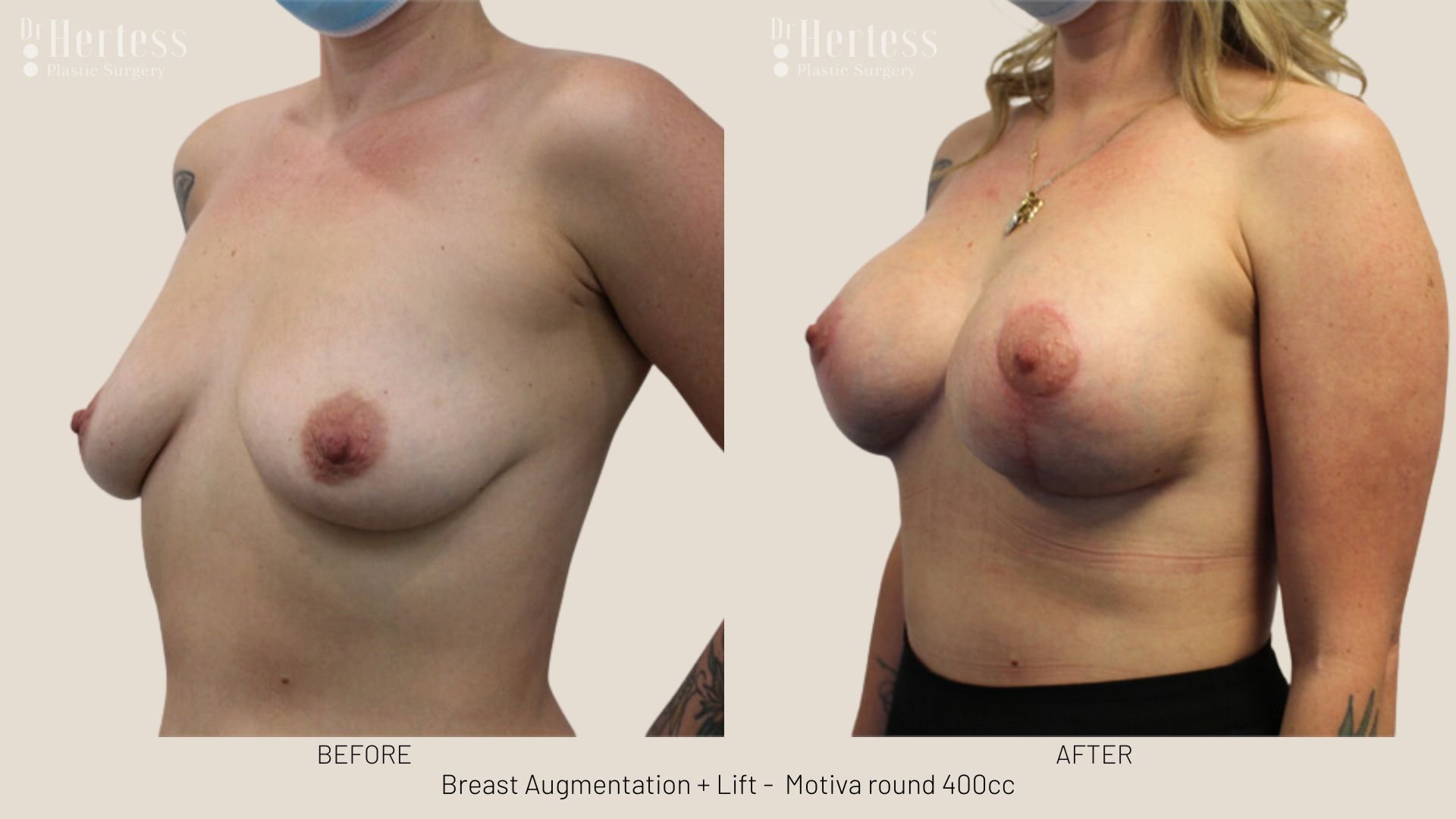 breast lift before and afters