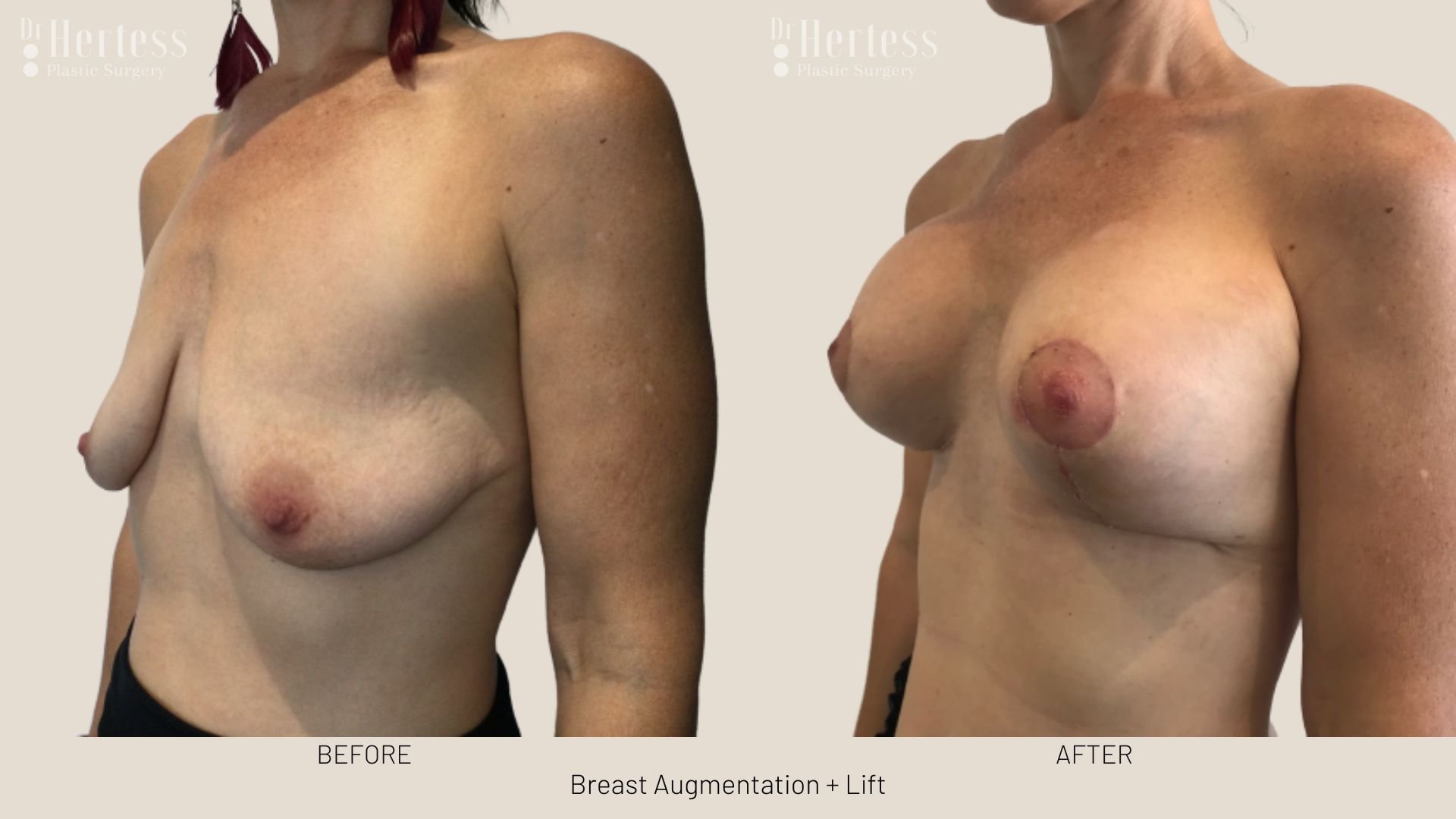 breast lift and augmentation before and after