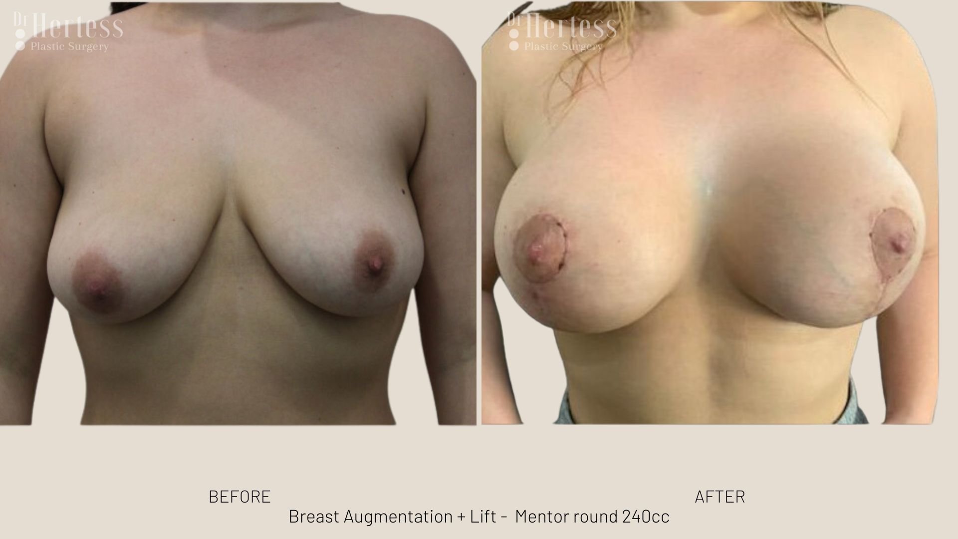 breast uplift mastopexy