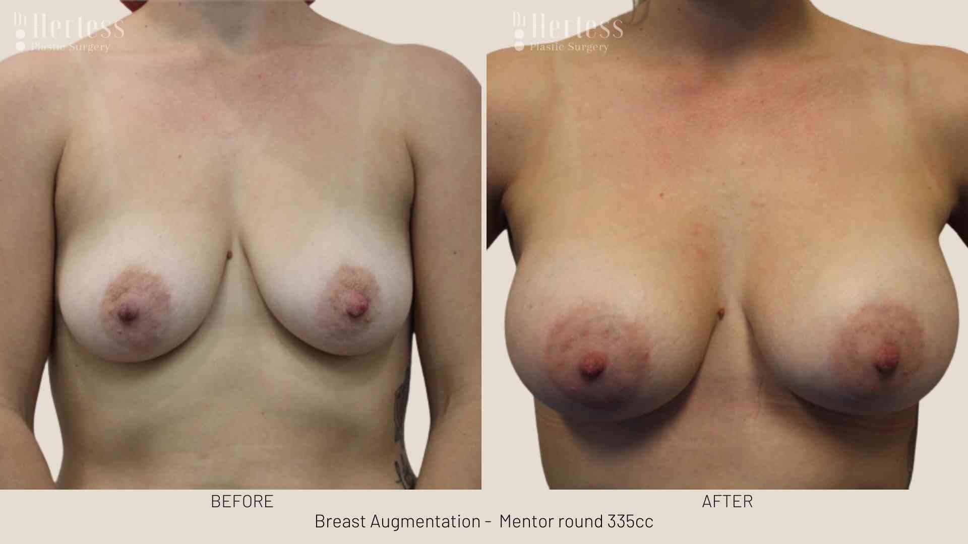 breast implant pics