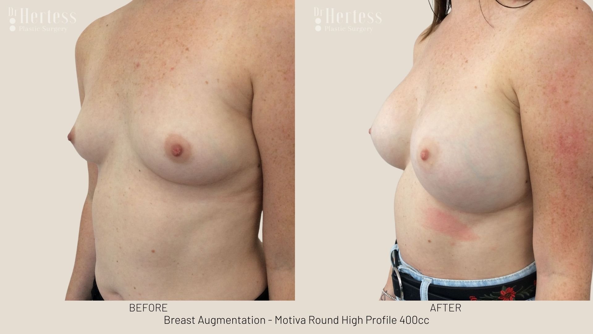 breast aug before and after