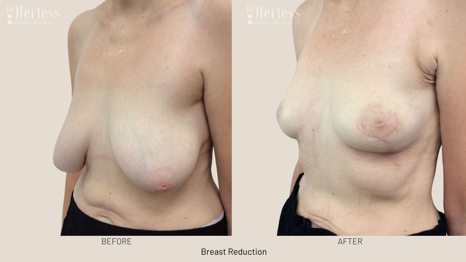 breast reduction photos