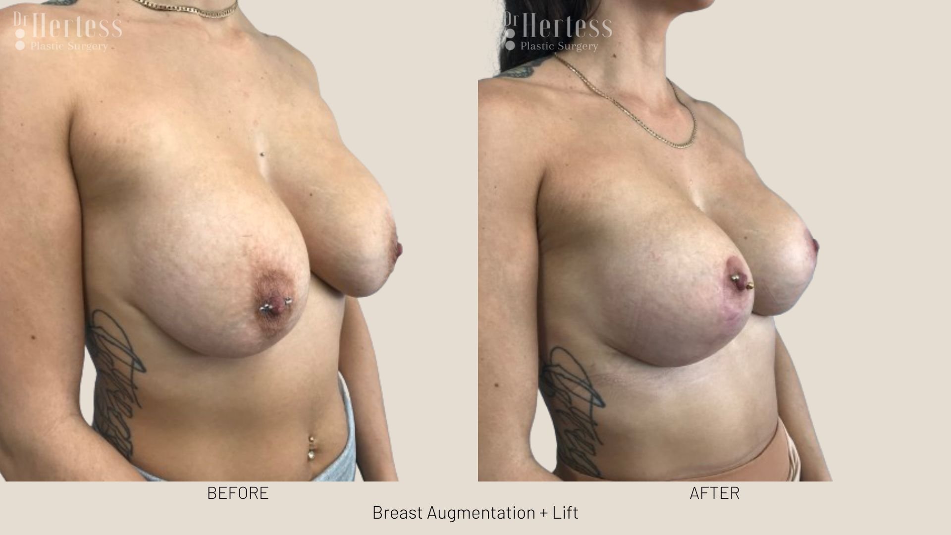 breast lift and augmentation before and after