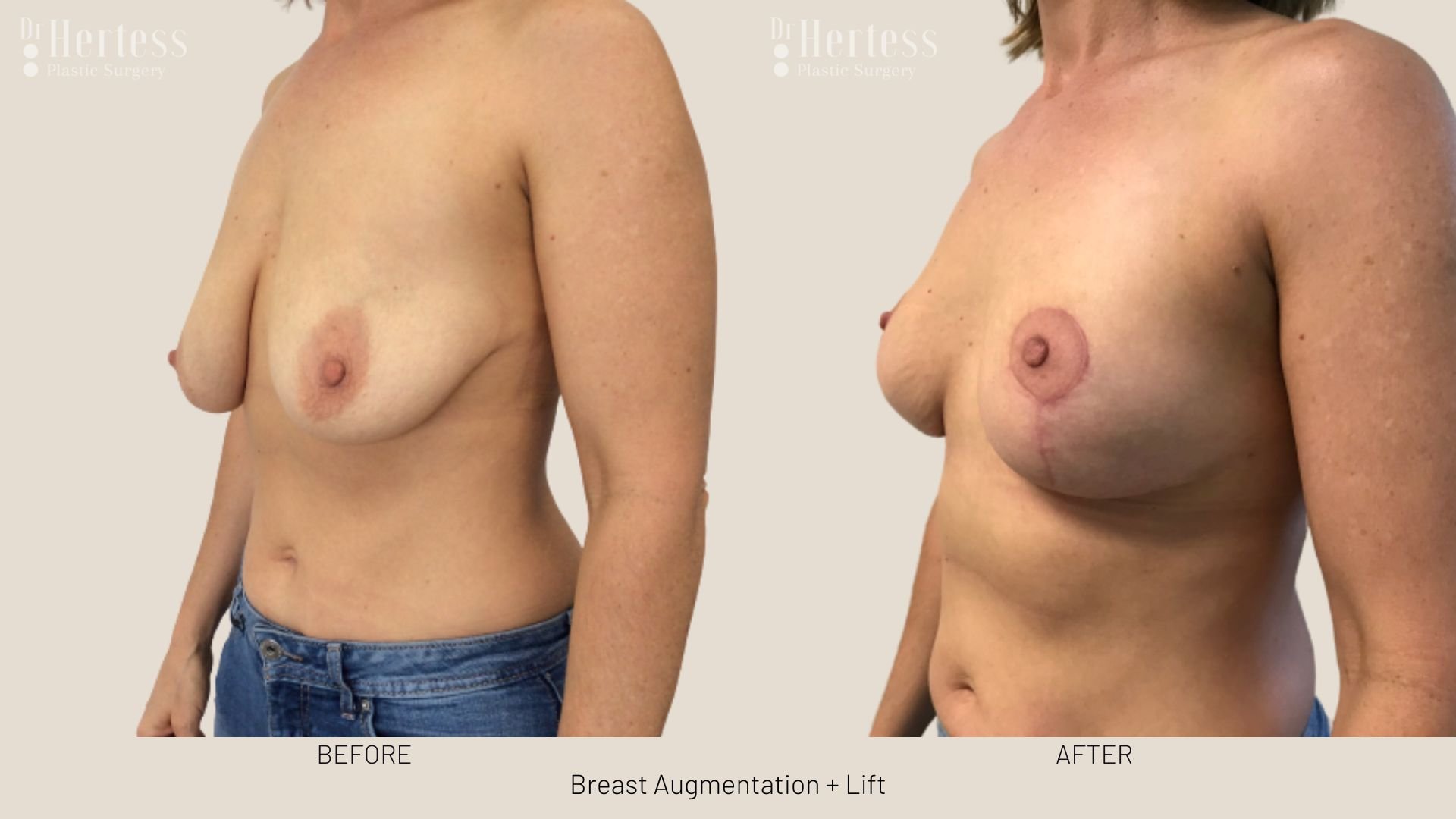 breast lift and augmentation before and after