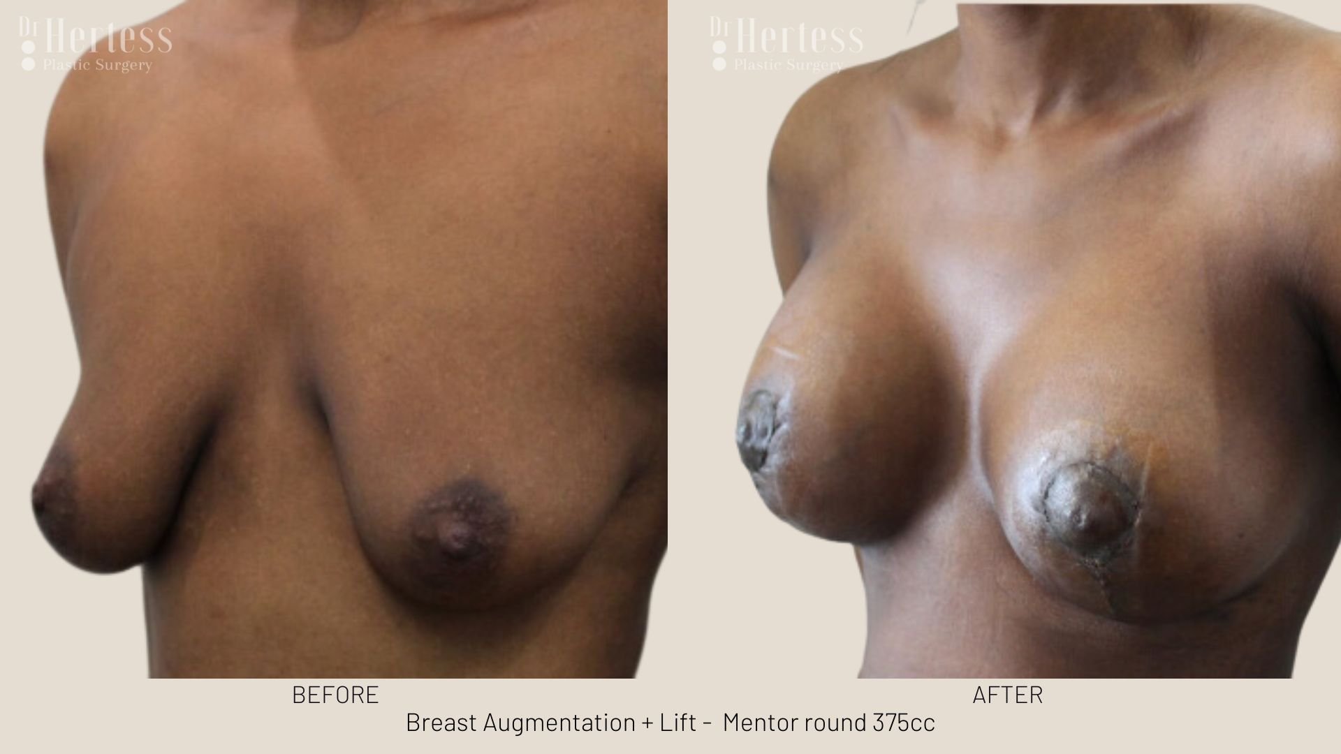 breast uplift mastopexy