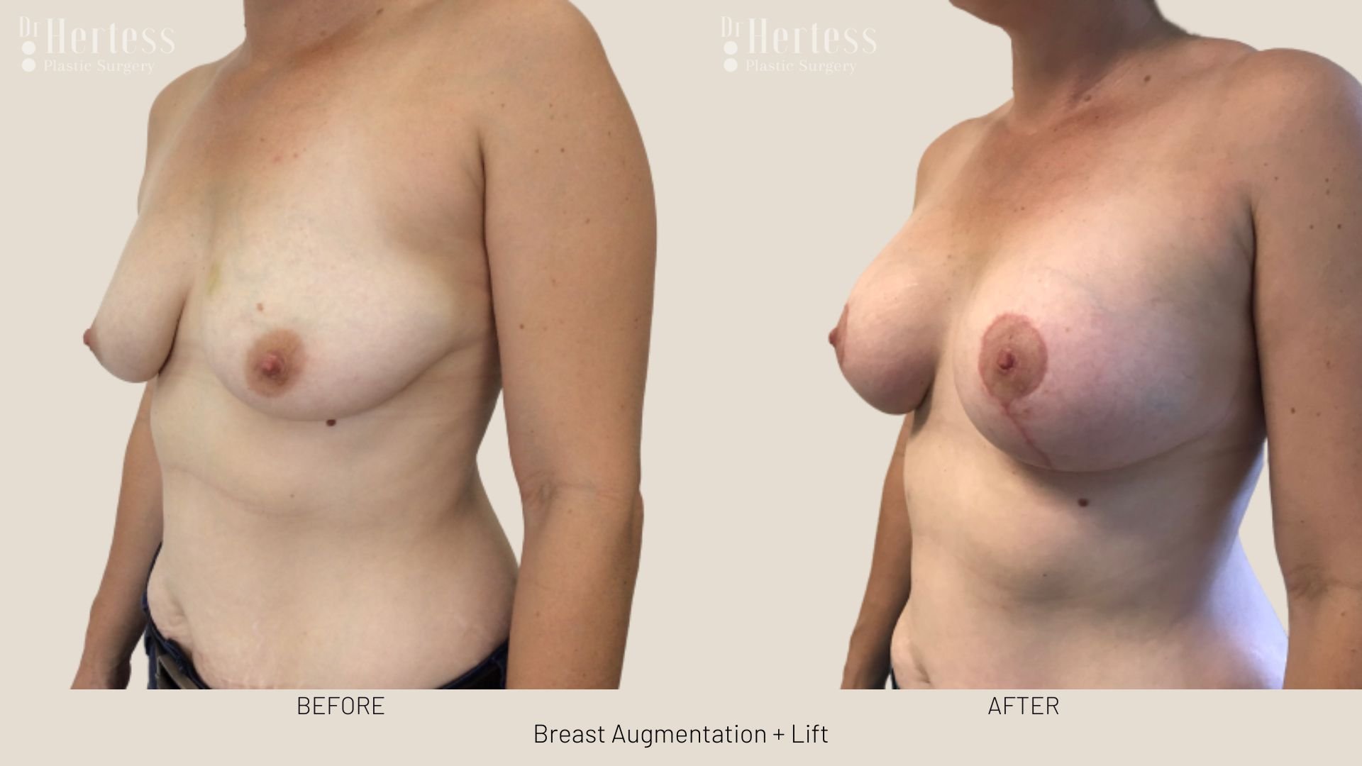 breast lift and augmentation before and after